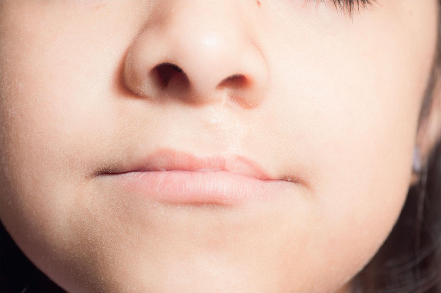 Figure 21.10.3, This patient has the scar characteristics of a Randall–Tennison-type cleft lip repair. Her lip demonstrates a nice three-dimensional shape, but the scar runs transversely across the midportion of her lip. This is the primary critique of this repair.