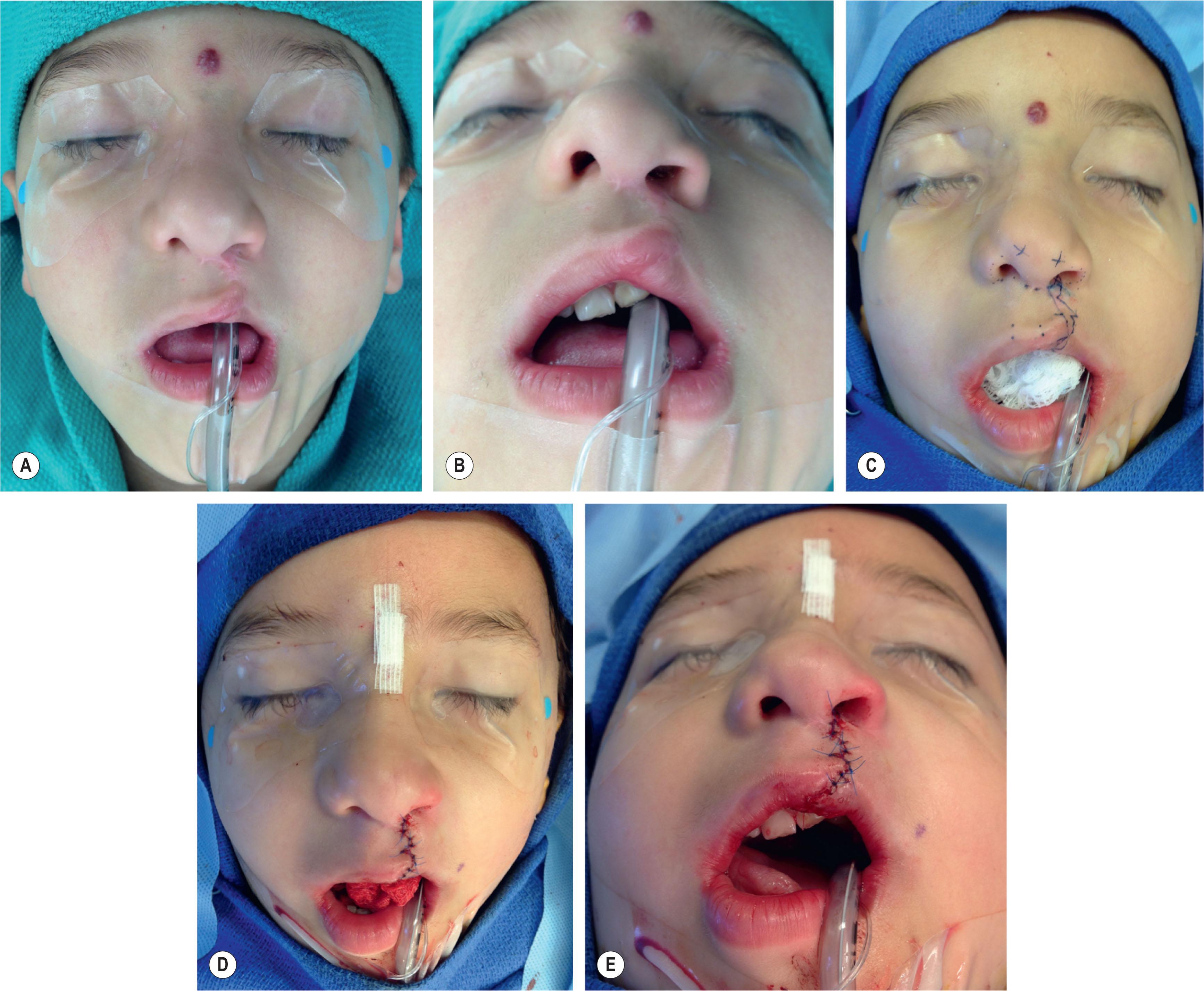 Figure 21.10.4, This young man has a notable step-off at the vermilion and significant cleft lip scarring. He also has scarring into the columella (A,B) . Markings were made to realign the white roll and excise the widened scar (C) , with the subsequent on-table result (D,E) .