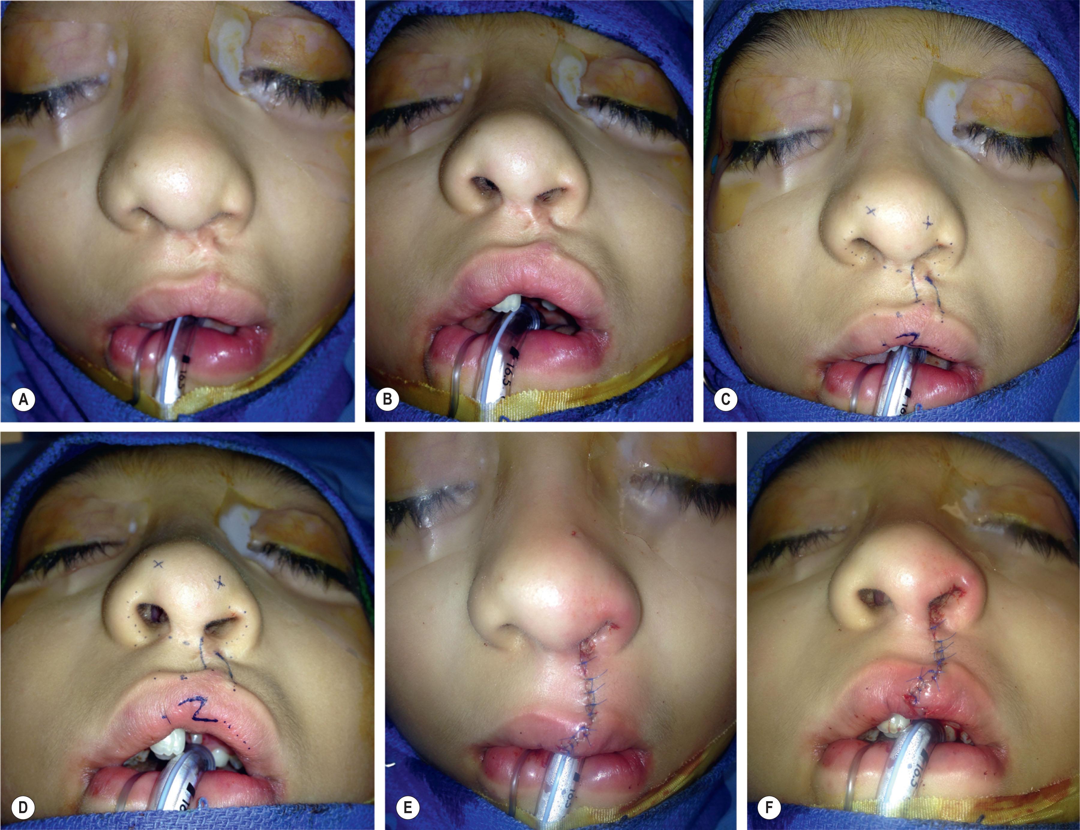 Figure 21.10.5, This young man demonstrates hypertrophic scarring, notching and discontinuity of the white roll, as well as vermilion mismatch at the red line (A,B) . Surgical intervention required excision of the areas of hypertrophic scarring, as well as Z-plasty-based rearrangement of the red line (C,D) . The immediate postoperative outcome is demonstrated (E,F) .