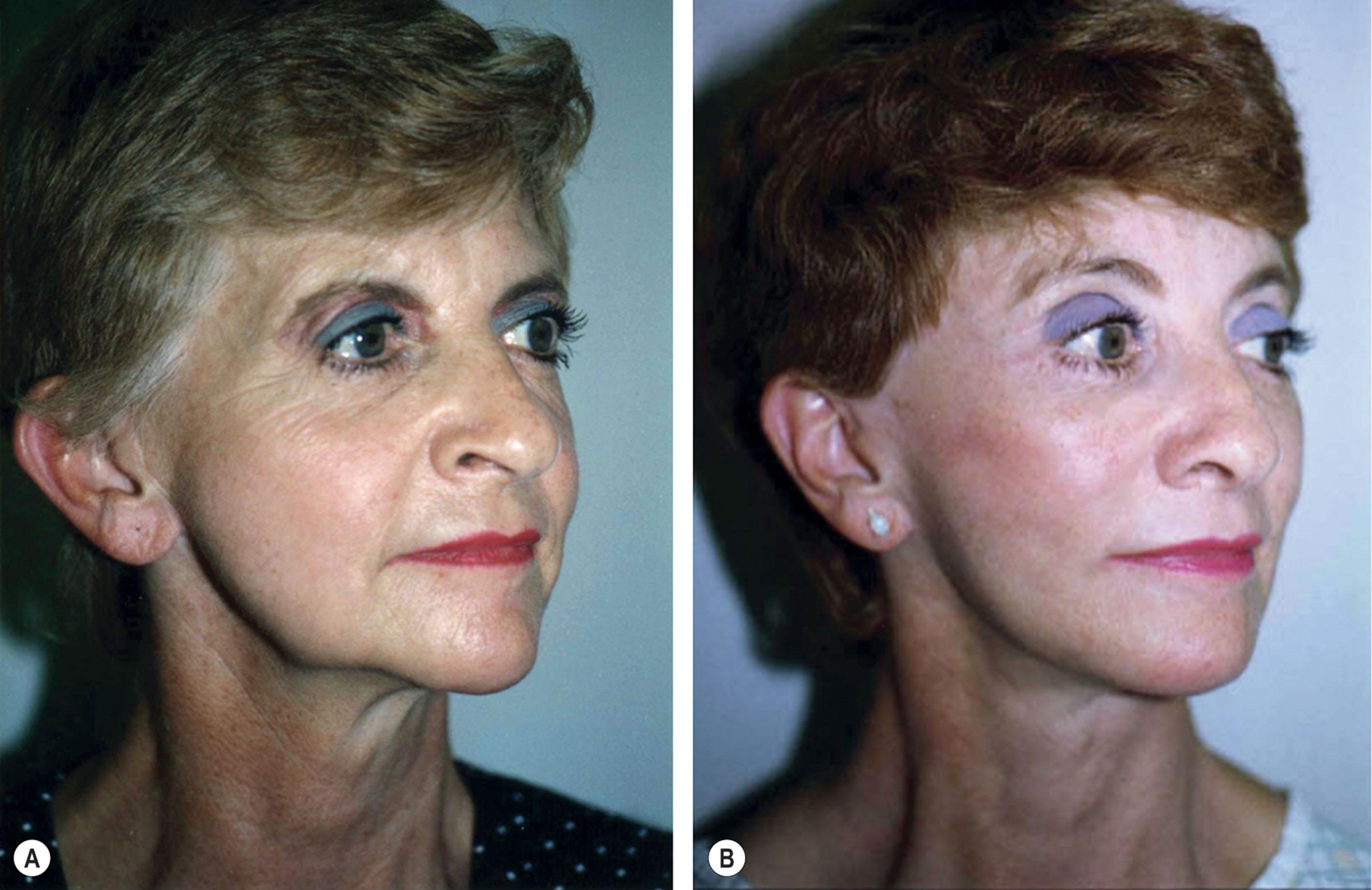 Figure 9.12.1, Skin lift and SMAS lift compared. Surgery does not arrest the aging process, and patients requesting secondary facelifts usually present with many of the same problems seen when they presented for their primary procedures. This is particularly true if the primary facelift was limited and consisted of skin excision and skin tightening only. (A) Patient age 61 seen after “skin only” facelift performed by an unknown surgeon (note scar in pretragal location). Residual problems seen include forehead ptosis, midface ptosis, heavy nasolabial folds, prominent labio-mandibular creases, cheek ptosis, infraorbital hollowing, malar flattening, jowl laxity, submental fat accumulation, and platysma band formation. Note that although some wrinkling and atrophy are present, the patient’s predominant problem is deep-layer tissue ptosis. Additional skin excision and tightening under these circumstances will be of little benefit to the patient. (B) Same patient seen age 63 after secondary facelift that used a high SMAS facelift technique. A forehead lift and necklift have also been performed The patient has more youthful facial contour and a soft, natural, and non-surgical appearance. Note elevation of eyebrow, elevation of lid–cheek junction, improved transition from the lower eyelid to the cheek, improved malar projection, softening of nasolabial fold, improved posture of the mouth, improved jawline contour, correction of residual jowl, and improved neck. Secondary procedure performed by Timothy Marten, MD, FACS.