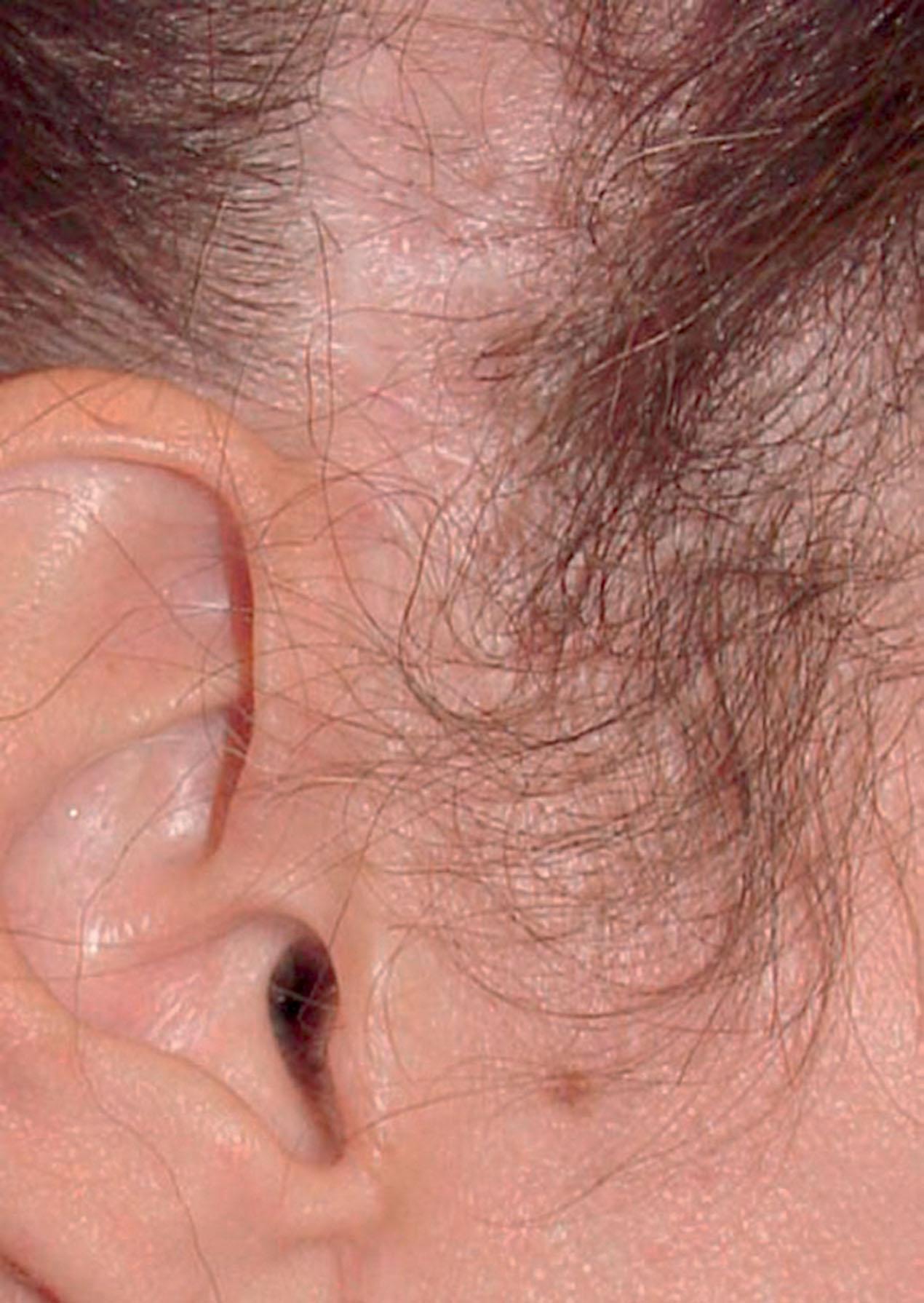 Figure 9.12.11, Temporal hair loss. Hair loss is frequently the result of improper shifting of scalp flaps along the wrong vector. This is commonly seen on the temporal scalp after well-intended but misguided attempts to smooth the forehead and glabella by excising temporal scalp and applying lateral traction on the forehead flap. Procedure performed by an unknown surgeon.