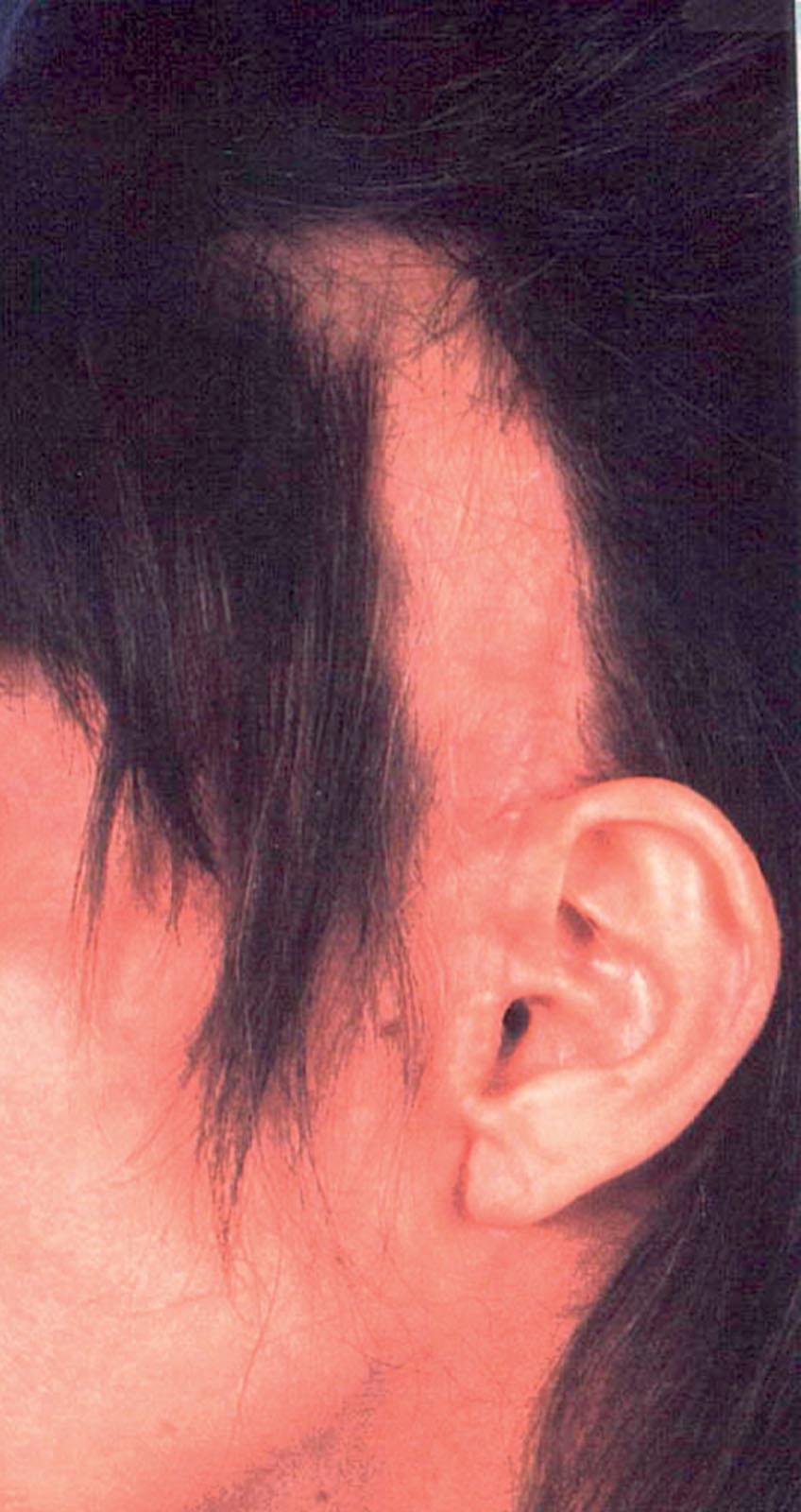 Figure 9.12.13, Large areas of hair loss. Large areas of hair loss are usually difficult to correct, especially if scalp excision was aggressive at the primary procedure and little residual redundancy is present. In such cases, complete correction may not be possible at the time of secondary facelift and hair transplantation, scalp flaps, and scalp expansion may be required. Procedure performed by an unknown surgeon.