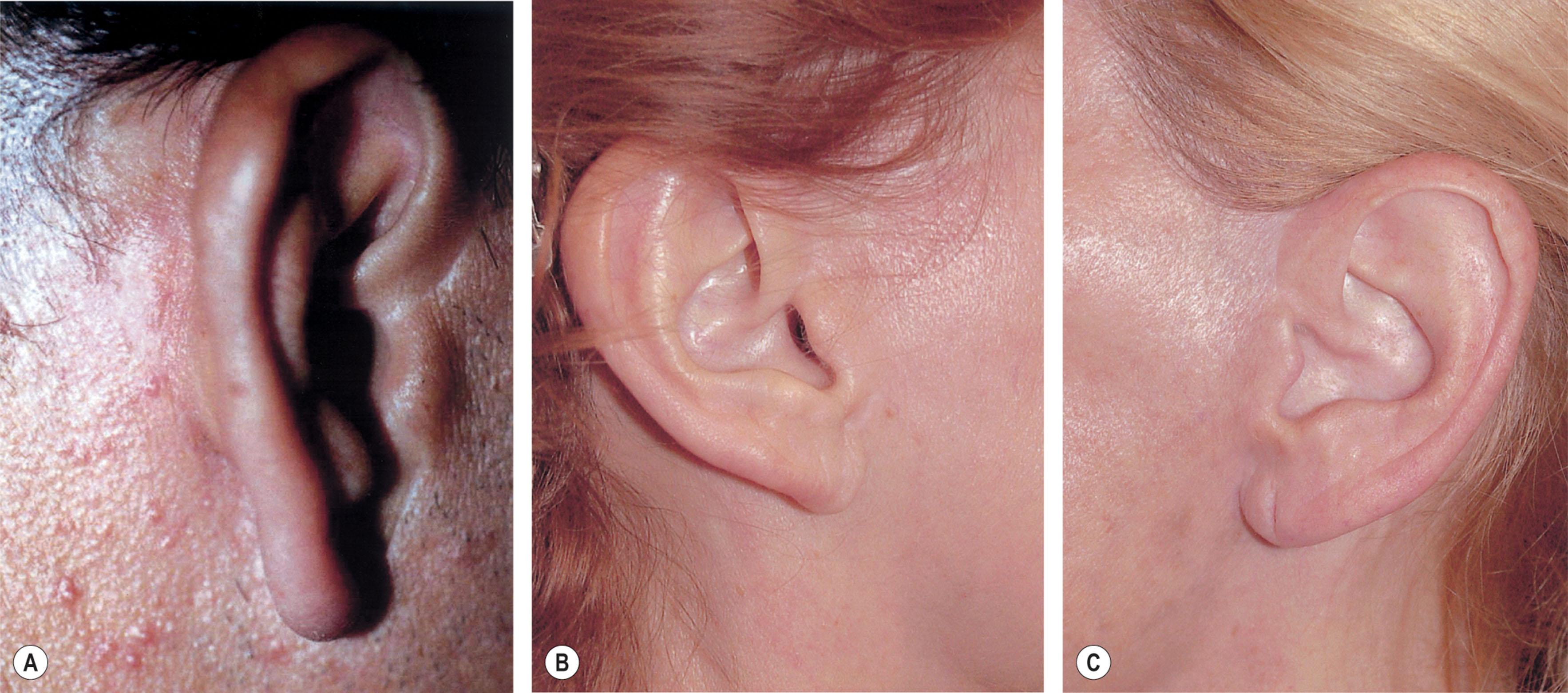 Figure 9.12.14, Retro-tragal scar. (A) The scar resulting from a properly situated retro-tragal incision will usually be inconspicuous, even if it is suboptimally healed, as the eye will mistake it for a reflected highlight. Note the well-concealed scar on this darkly complexioned patient. A scar of the same type would be more obvious if the incision had been placed in a pretragal position. (B) A healed retro-tragal facelift incision in another patient with fair skin. Transitions of color and texture are hidden along natural interfaces. (C) A healed retro-tragal facelift incision on another patient. If the incision is closed carefully, a natural appearance without anatomic distortion should result. Procedures performed by Timothy Marten, MD, FACS.