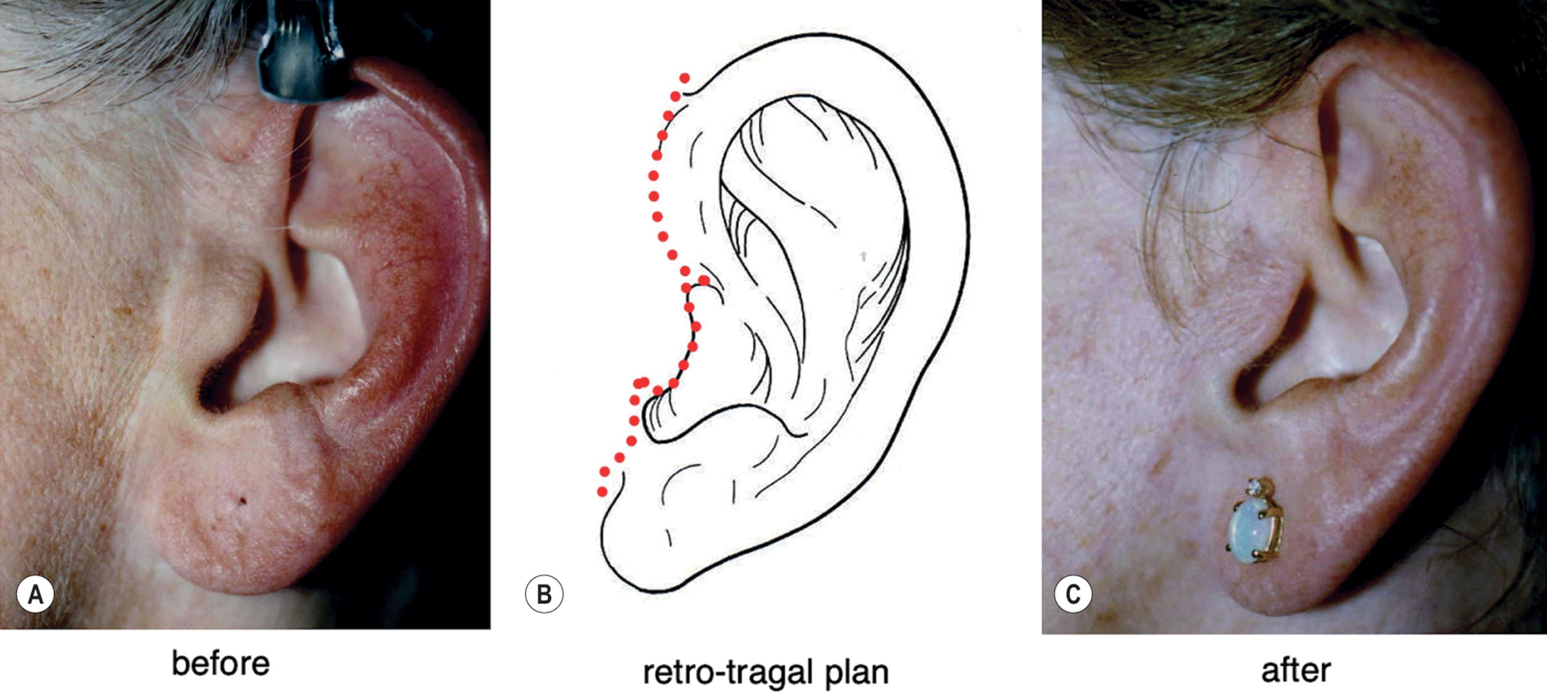 Figure 9.12.18, Pretragal and retro-tragal incisions compared. (A) Pretragal incision in a patient presenting for secondary facelift. The scar has healed satisfactorily but attention is drawn to it due to differences in color and texture on each side of it. Procedure performed by an unknown surgeon. (B) Plan for relocating incision to retro-tragal position at secondary facelift. (C) Same patient as in (A) after secondary facelift in which incision was moved to a retro-tragal position. Color and texture differences, and the scar itself, are hidden along natural anatomic interfaces. Procedure performed by Timothy Marten, MD, FACS.