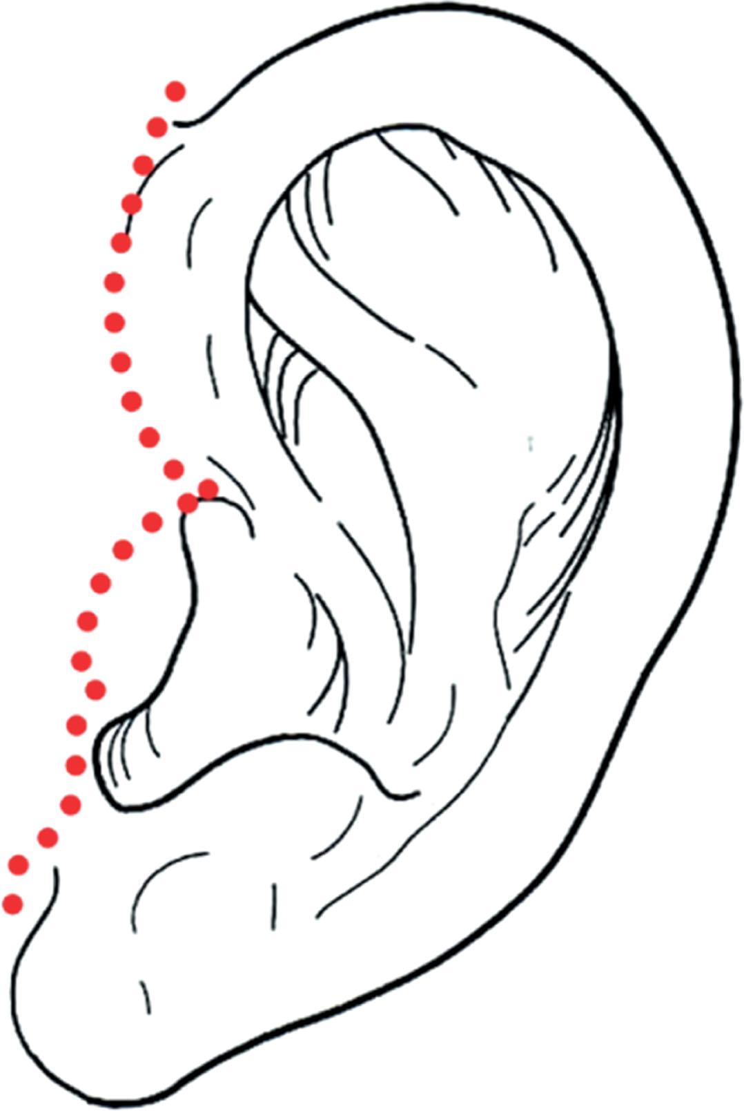 Figure 9.12.17, Modified pretragal incision plan if cheek skin deficiency is present. Although it is typically best to plan the pre-auricular incision in a retro-tragal location (see Figures 9.12.14 and 9.12.18 ) if inadequate cheek skin is available to recruit for the repair a defect with be created that will be difficult to properly close. In such cases the modified plan can be used. If adequate skin can be recruited the island of skin on the tragus can be excised and the scar sited in a retro-tragal location. If inadequate skin is recruited to move the scar to a retro-tragal location this incision plan will typically result in a satisfactory, albeit, sub-optimally situated scar.