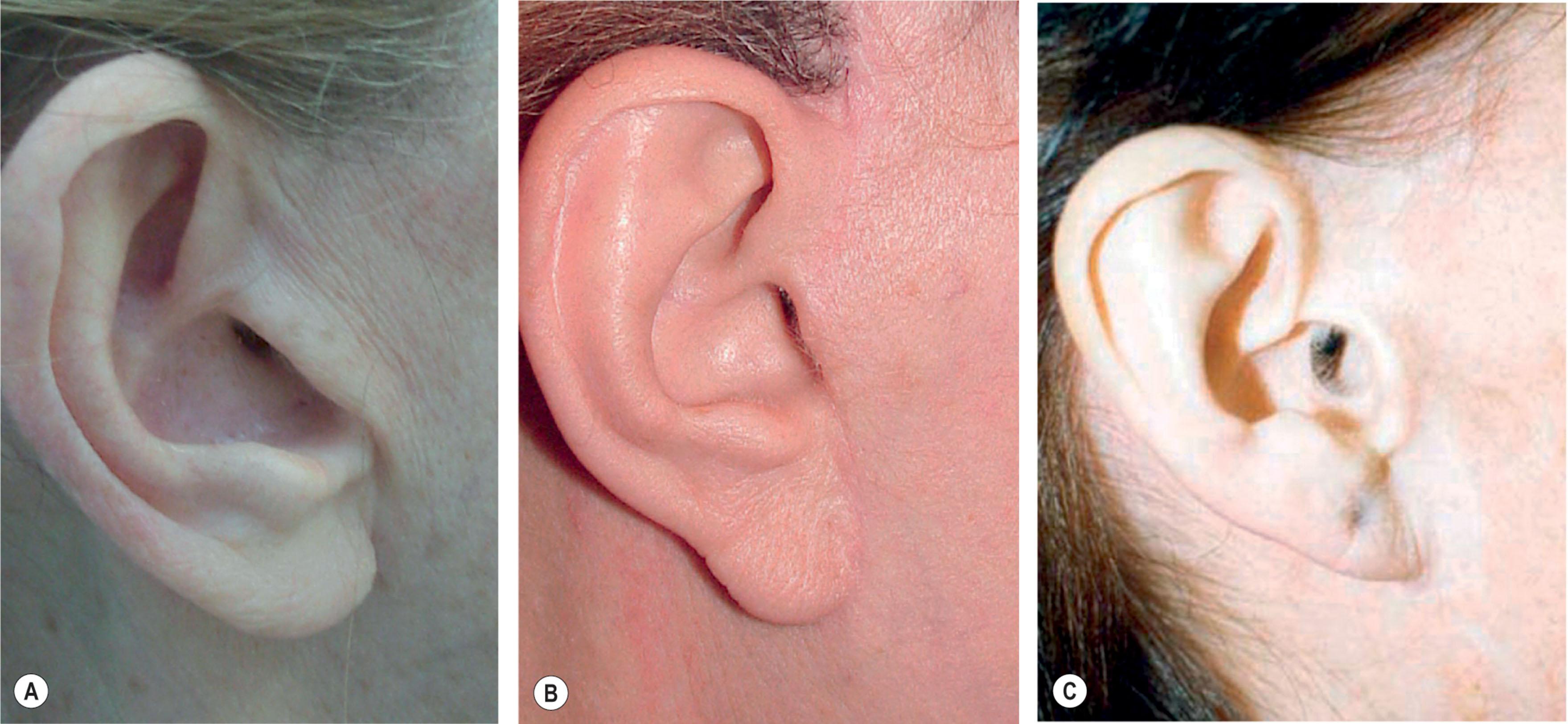 Figure 9.12.27, “Chopped-off”, “buried”, and “retracted” tragal irregularities. (A) In the “chopped-off” tragus irregularity the tragus is seen to have no distinct beginning or end and no posterior projection. It is usually the result of improper incision planning, superiorly over-shifting of the cheek skin and imprecise trimming of the tragal flap. (B) In the “buried” tragus irregularity the tragus appears indistinct from the cheek anterior to it and the normal pretragal depression is absent. This irregularity results from failure to leave enough skin to fill the pretragal sulcus and is commonly seen when tension is placed on the cheek skin flap. (C) The “retracted tragus” represents an extreme case of the “buried tragus” irregularity and is the result of an over-trimmed cheek skin flap. The retracted tragus irregularity differs from the buried tragus irregularity, however, in that not only is the pretragal sulcus obliterated, but the tragal cartilage itself is pulled anteriorly. This results in an open auditory canal and a tell-tale and unnatural appearance. All procedures performed by unknown surgeons.