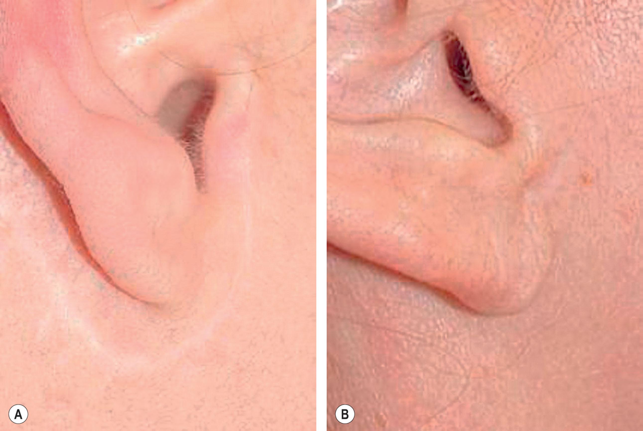 Figure 9.12.19, Improper and proper placement of the perilobular incision. (A) The perilobular incision has been made too far inferiorly and is evident even on casual inspection. Although an extreme example is shown, if the scar is still visible less extreme inferior placement is almost equally objectionable. Procedure performed by an unknown surgeon. (B) A different patient seen after facelift. The perilobular scar has been placed more superiorly and in such a manner that it is tucked up and hidden by the lobule itself. In this location it cannot be seen. Procedure performed by Timothy Marten, MD, FACS.