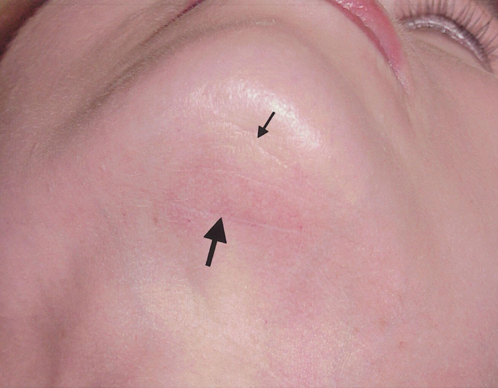 Figure 9.12.22, Placement of the submental incision. Close-up view of the submental region of a patient after secondary facelift. A previous incision had been made directly in the submental crease (small arrow). The incision used at the secondary procedure was made posterior to the prior incision (large arrow), and the scar and crease were released and intradermally fat grafted. Smooth submental contours are present, and both scars are inconspicuous.