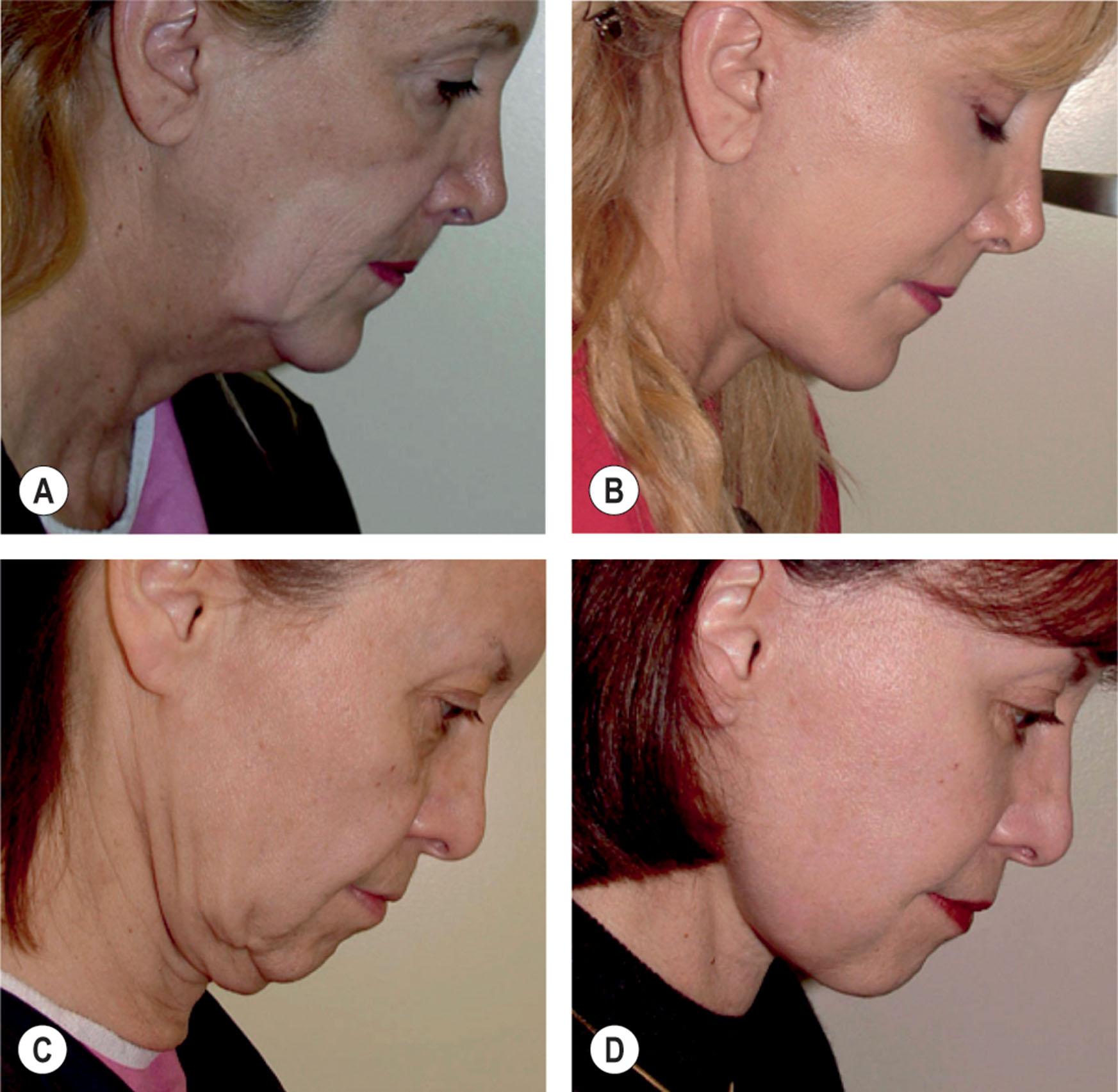 Figure 9.12.23, Correction of the double chin and witch’s chin irregularities. If the submental incision is placed posterior to the submental crease, the submental retaining ligaments can be released and the fat of the chin and the neck blended. (A,C) Patients with double chin before secondary facelift. Procedures performed by unknown surgeons. (B,D) Same patients after secondary facelift. The submental incision was made 1.5 cm posterior to the submental crease, the submental restraining ligaments released, and the subcutaneous fat of the chin and the submental areas sculpted and blended to achieve optimal contour. Platysmaplasty, transverse platysma myotomy, and submandibular gland reduction were also performed. Procedures performed by Timothy Marten, MD, FACS.