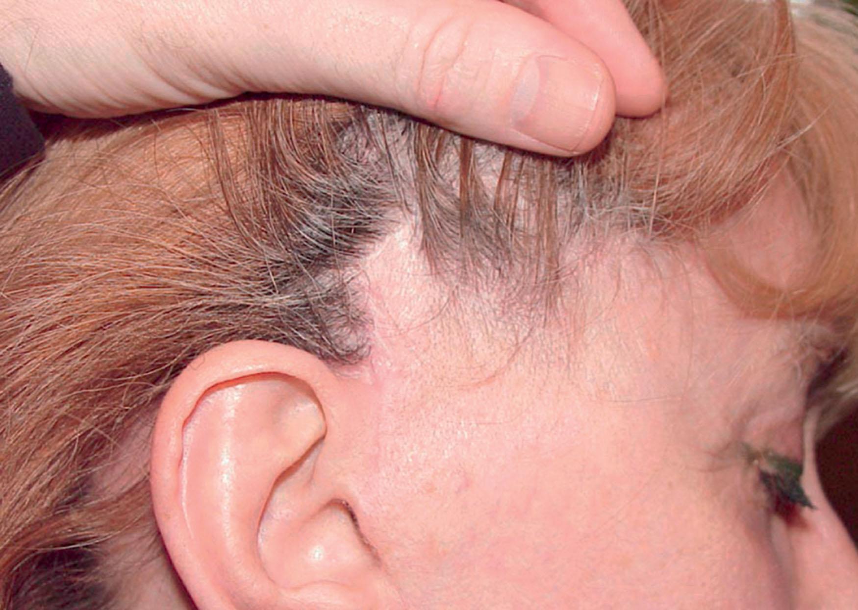 Figure 9.12.3, Sideburn elevation and displacement of the temporal scalp after multiple facelifts. A secondary facelift using the same incision plan as at the primary procedure has resulted in the tell-tale displacement of temple hair and elevation of the sideburn. Procedure performed by an unknown surgeon.