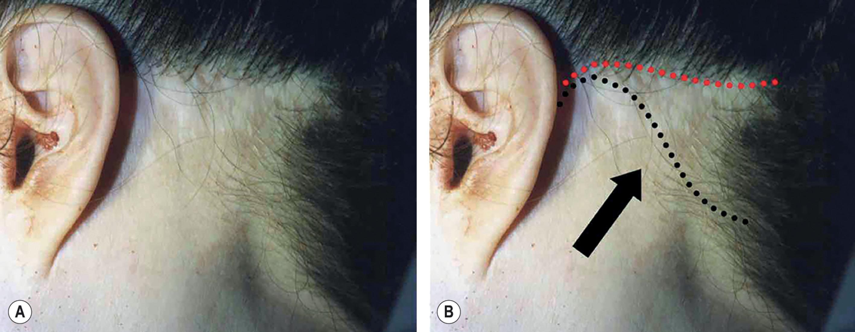 Figure 9.12.6, Understanding the cause of occipital hairline displacement. (A) An example of avoidable notching and displacement of the occipital hairline seen in a patient whose surgeon inappropriately used a traditional occipital incision plan (procedure performed by an unknown surgeon) (see also Fig. 9.12.7 ). (B) Deconstruction of the occipital hairline displacement seen in (A) . The surgeon made a well-intended, but conceptually flawed attempt to hide the scar in the occipital scalp (dotted red line) after underestimating the skin redundancy in the upper-lateral neck. Skin has been advanced (black arrow) into a position where scalp hair should be and the hairline is “notched”. The dotted black line shows the incision plan that would have prevented the problem.