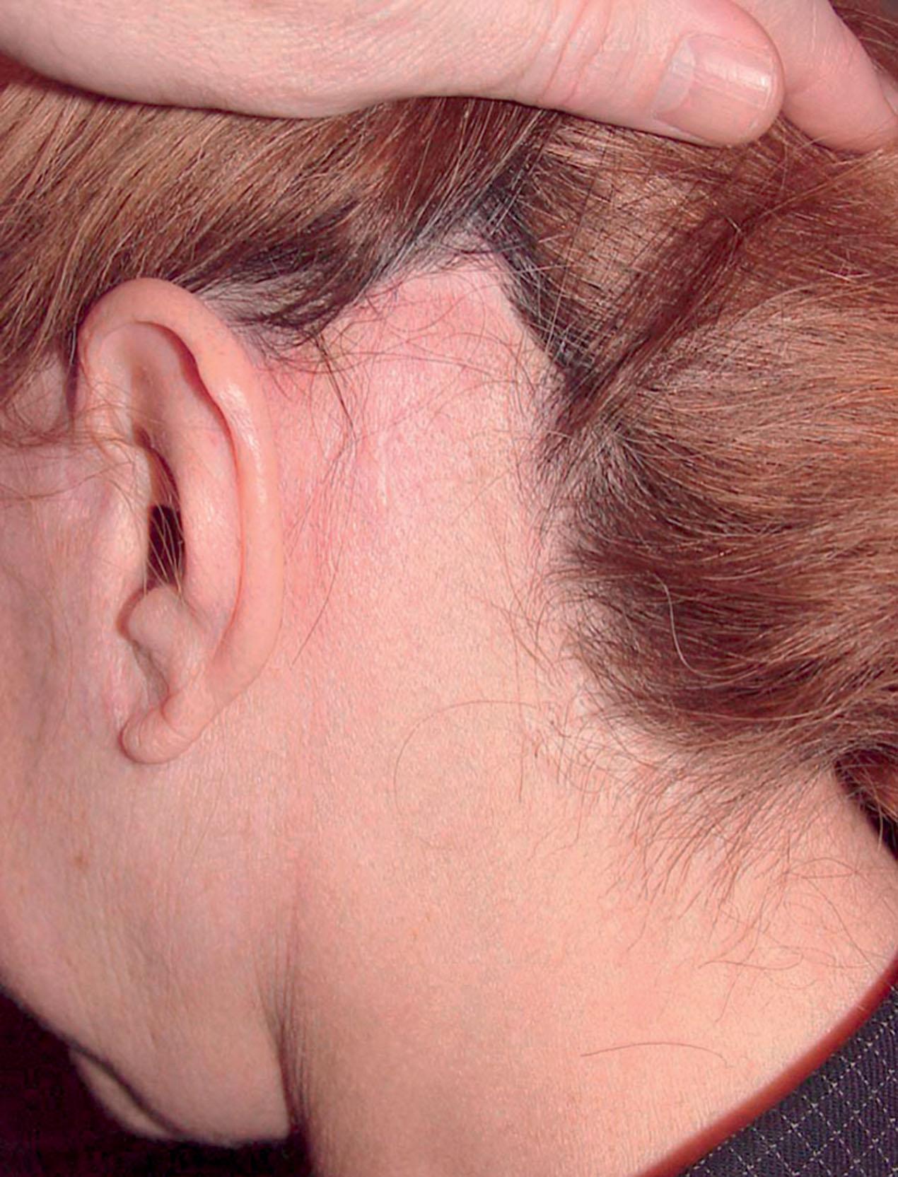 Figure 9.12.7, Elevation and displacement of the occipital scalp after multiple facelifts. A secondary facelift using the same incision plan as at the primary procedure has resulted in the objectionable displacement of the hairline. Procedure performed by an unknown surgeon (see Fig. 9.12.8 ).