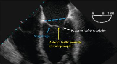 Fig. 18.2, Pseudoprolapse of the Anterior Mitral Leaflet in Secondary Mitral Regurgitation (MR) Due to Severely Restricted Posterior Leaflet Motion.