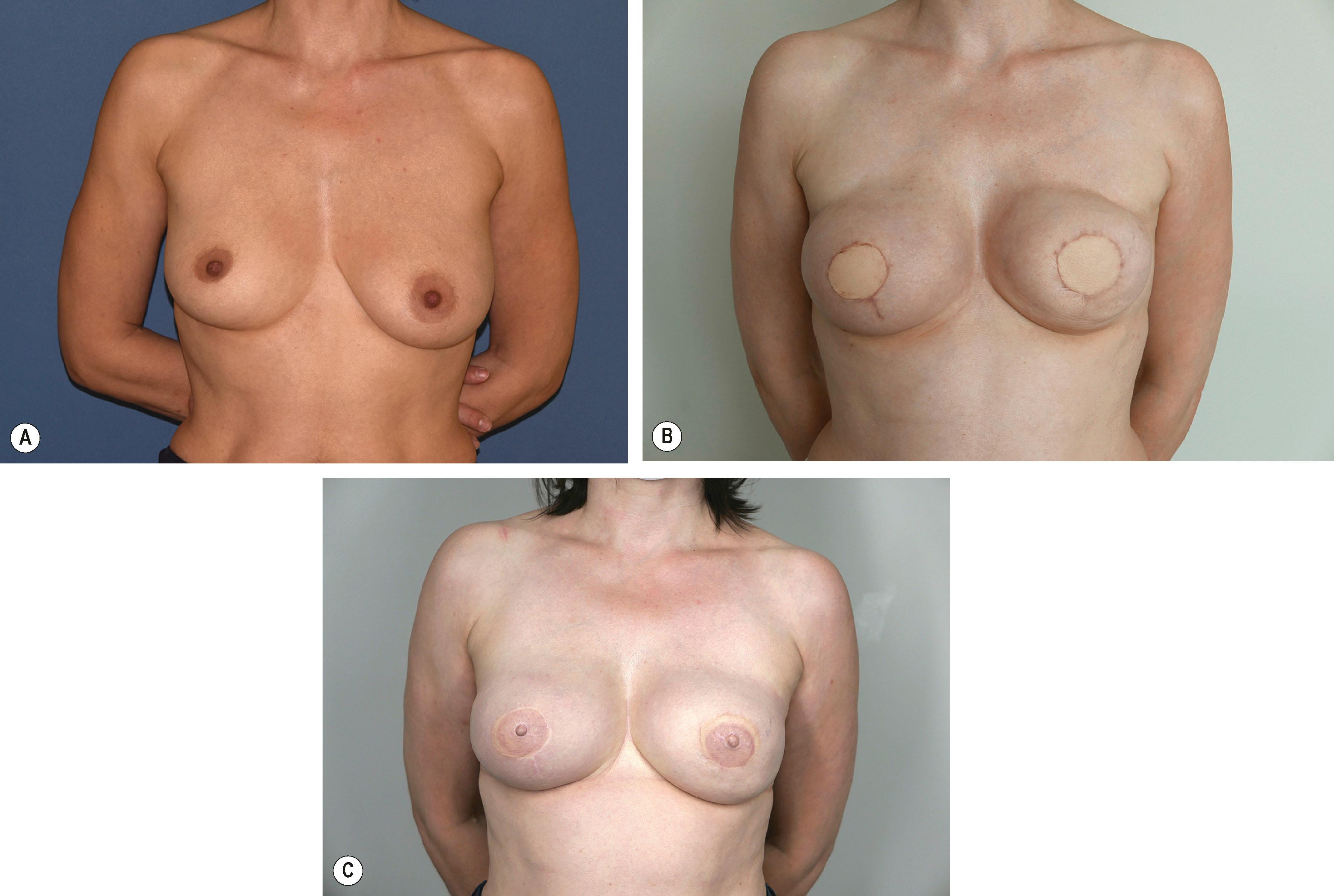 Figure 43.1, (A) A 46-year-old patient with bilateral carcinoma of the breast and asymmetry. (B) 3 months following bilateral skin-sparing mastectomy (SSM) and primary autologous reconstruction with superior gluteal artery perforator flap. Secondary procedures planned after 6 months: autologous fat graft to both upper poles; bilat. nipple–areolar complex reconstruction. (C) Follow-up at 3 months after fat grafting (40 cc right side;150 cc left side) and areolar tattooing.