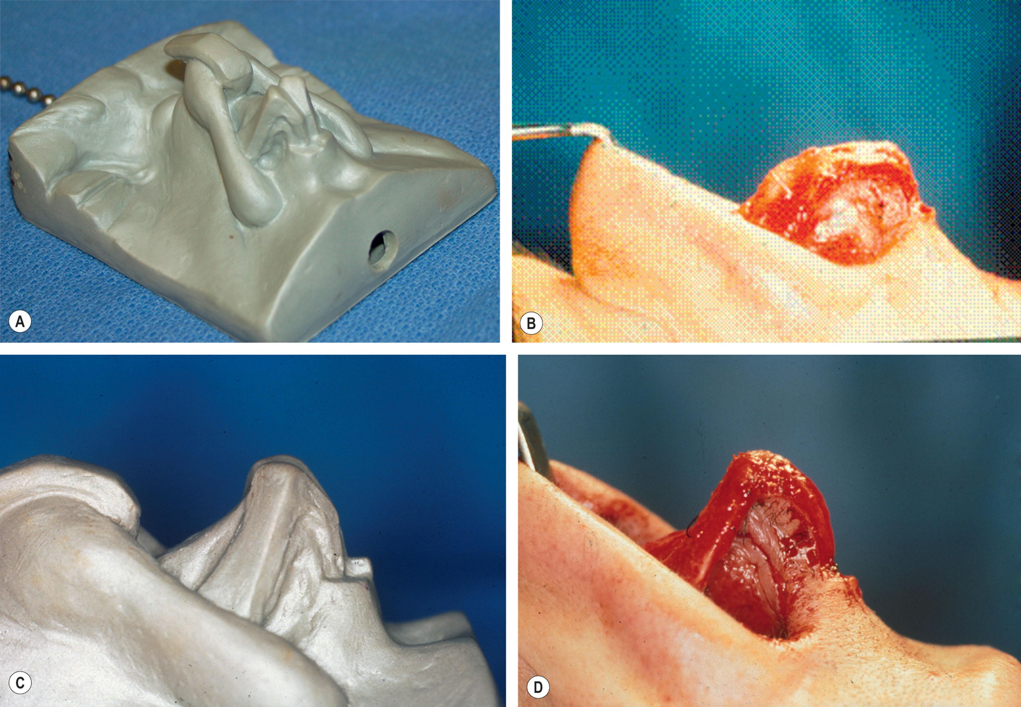 Figure 22.2, (A) This autoclavable model of the prototype ideal framework for the nose makes it easy for the surgeon to perform their biological sculpting. Copying from a model is much easier than memorizing the angles and relationships between various parts of the tip complex. (B) The deformed nasal tip should ideally look something like the prototype model. (C,D) Appearance after suture techniques, excisional techniques, and grafts are complete.