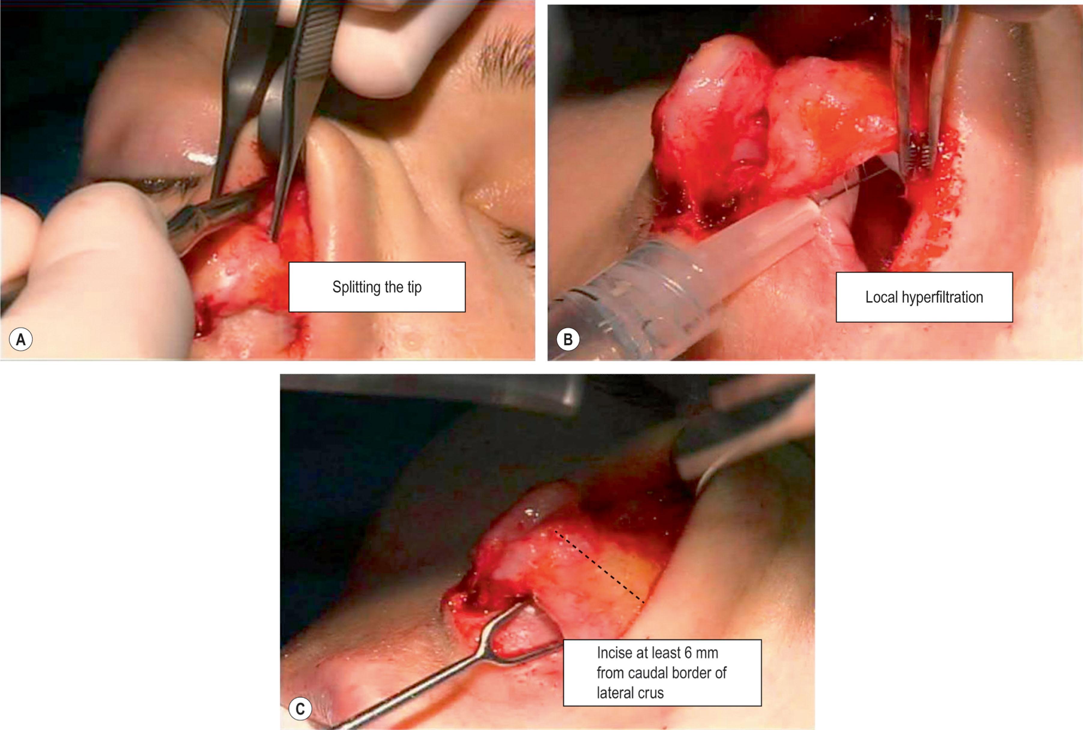 Figure 22.3, (A) The best way to get control of a fibrotic amorphous tip is to first split it down the middle beginning with the dorsum. The anterior septal angle will become exposed, and then one can split the middle crura apart. Doing so avoids losing structural integrity, which occurs when trying to dissect the entire scar in an attempt to find the cartilaginous framework. (B) Hyperinfiltration with local anesthesia helps. (C) If the junction between the upper lateral cartilages (ULC) and lateral crus is not visible because of scarring, the tip complex is separated from the ULC by arbitrarily making an incision at least 6 mm from the marginal incision. By spreading in that incision, the tip complex becomes separated from the ULC and mobile for rotation or derotation.