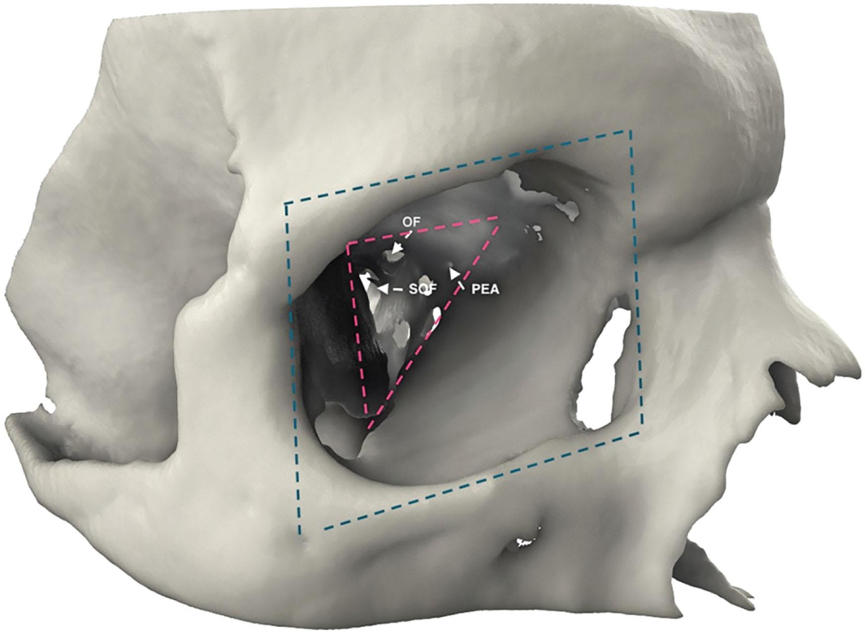 Figure 5.1, The orbit comprises a four-sided pyramid at its base (blue dotted line), tapering to a three-sided pyramid towards the apex (red dotted line). The superior orbital fissure (SOF) and optic foramen (OF) are located within the orbital apex. The posterior ethmoidal artery (PEA) is a good landmark for the safe limit of subperiosteal dissection, given its proximity to the optic foramen.