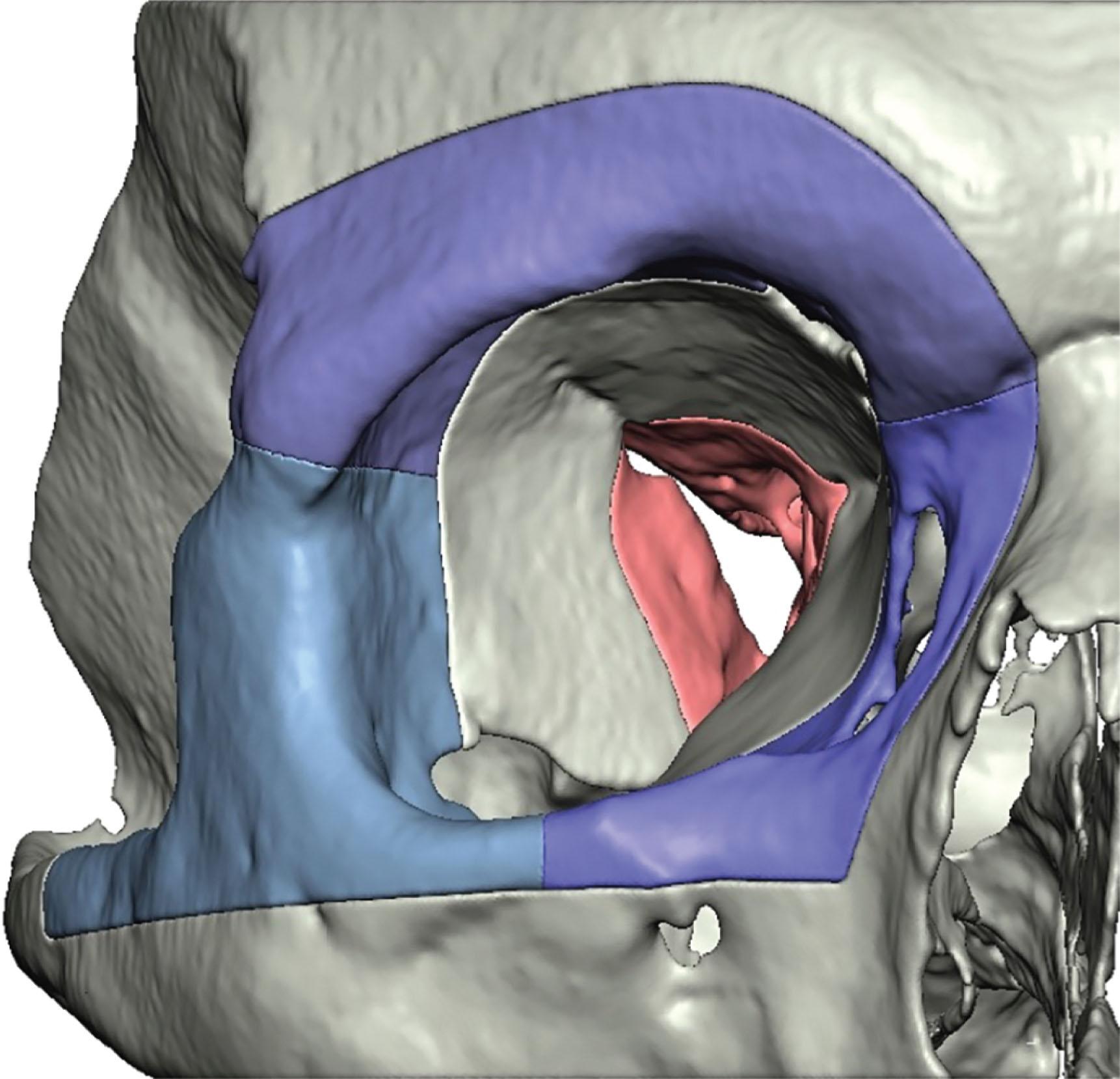 Figure 5.2, The bony orbit is subdivided into two main components for surgical considerations. The deep orbital cavity or orbital apex (red) is the fixed segment of the orbital cavity which accommodates the critical structures passing through the optic foramen and superior orbital fissure. The circumferential bony rim of the orbit is composed of thick resilient bone which defines the shape and dimensions of the orbital aperture (shades of blue/purple). The latter is the movable orbit, which can be safely transposed in any direction, in one or multiple segments (supraorbital, nasoethmoid, and/or orbitozygomatic).