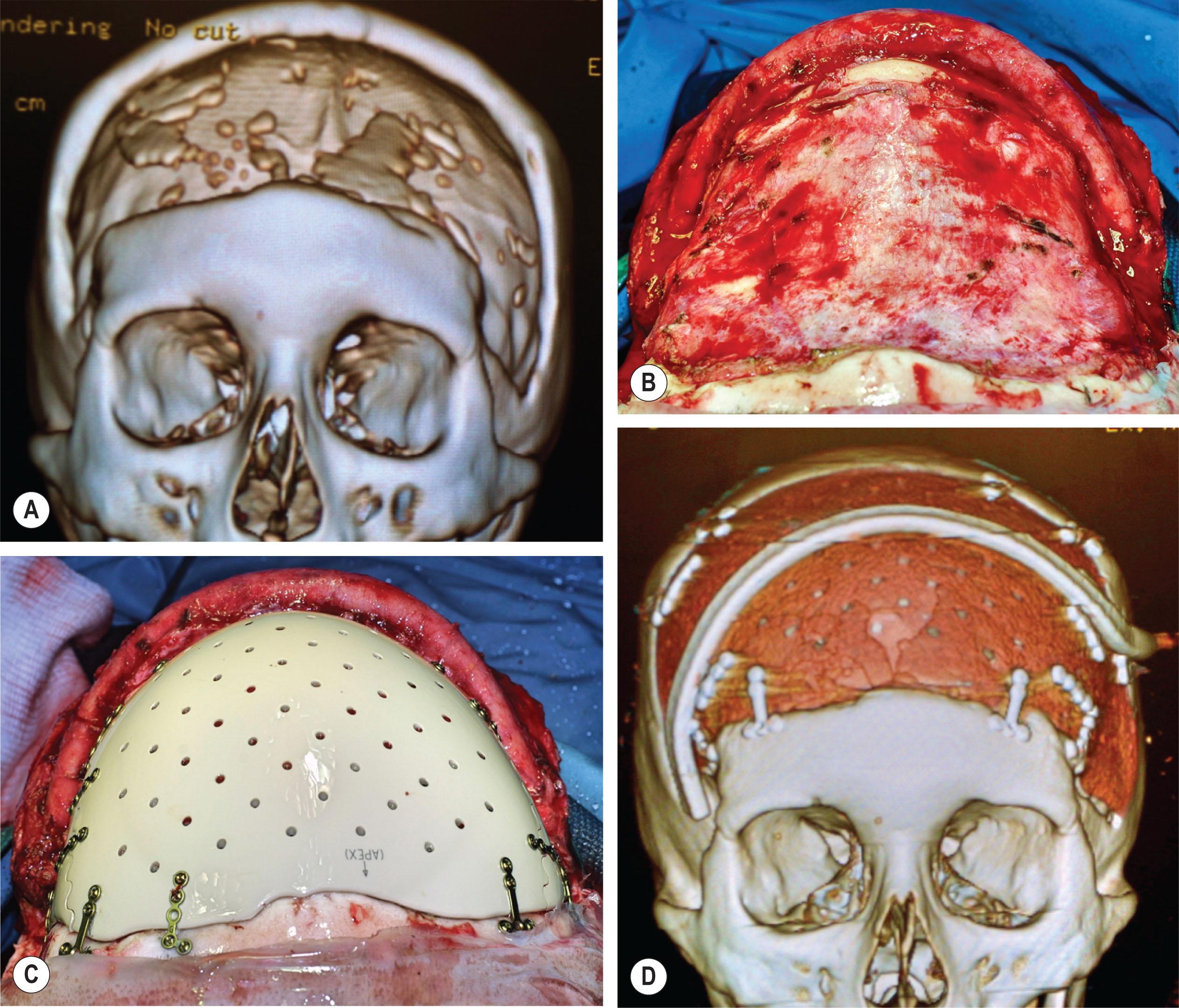 Figure 5.4, (A) Post-craniotomy full-thickness bifronto-temporo-parietal skull defect. (B) The defect is superior to the paranasal sinuses which are not exposed. (C) Computer modeling and rapid prototyping allowed prefabrication of a patient-specific polymer implant. (D) Postoperative imaging shows restoration of normal cranial morphology.