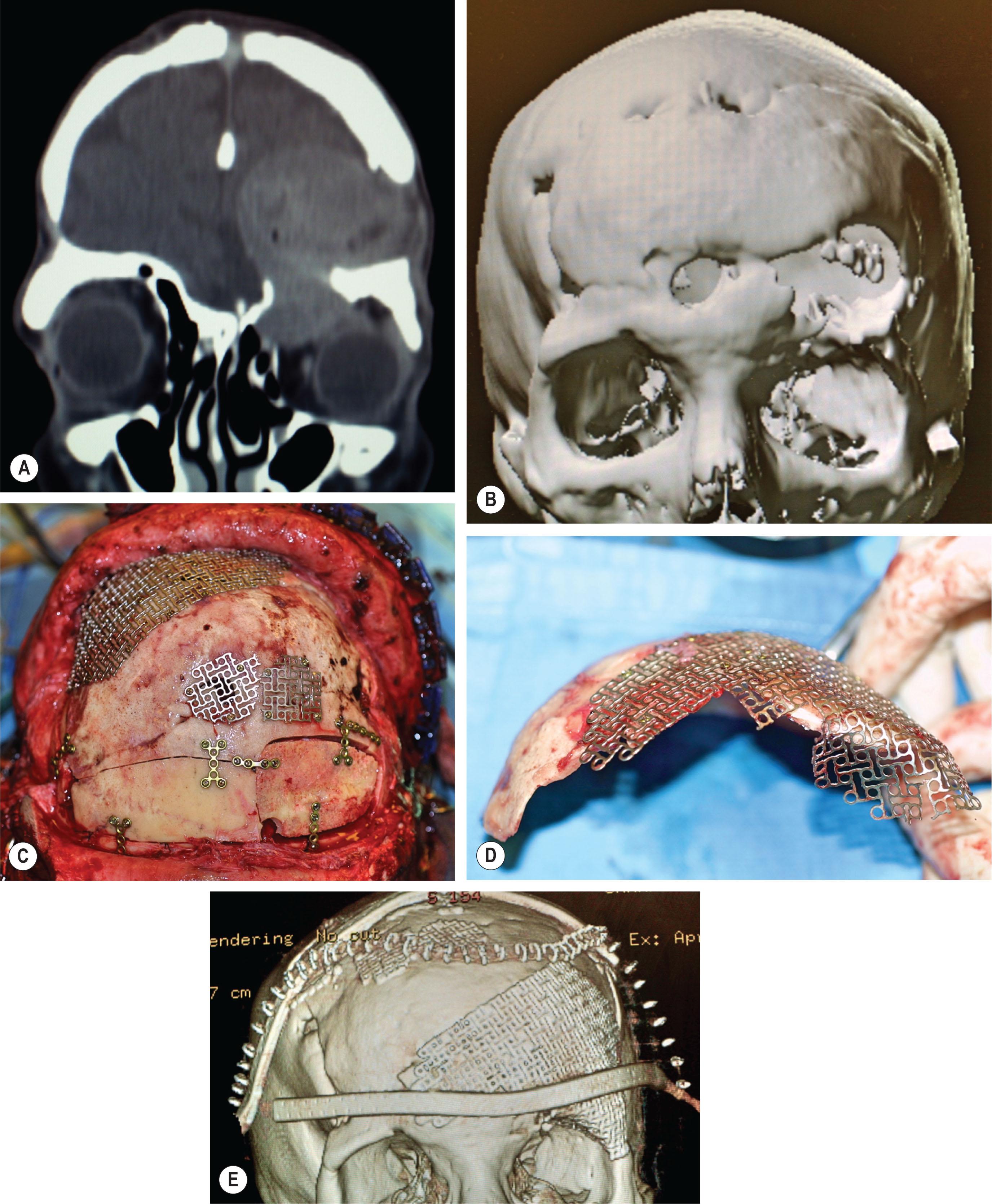 Figure 5.5, Osteomyelitis and infected mucocele, eroding through the left orbital roof into the orbit (A) , and through the full thickness of the frontal bone (B) . (C,D) Surgical management involved mucocele eradication, left fronto-orbital bone excision, and frontal sinus obliteration with cancellous iliac crest autograft. Intra-operative images show reconstruction of the “unknown” or intra-operative defect with patient-specific titanium mesh and split cranial bone graft. (E) Postoperative 3D CT demonstrates restoration of normal cranial morphology.