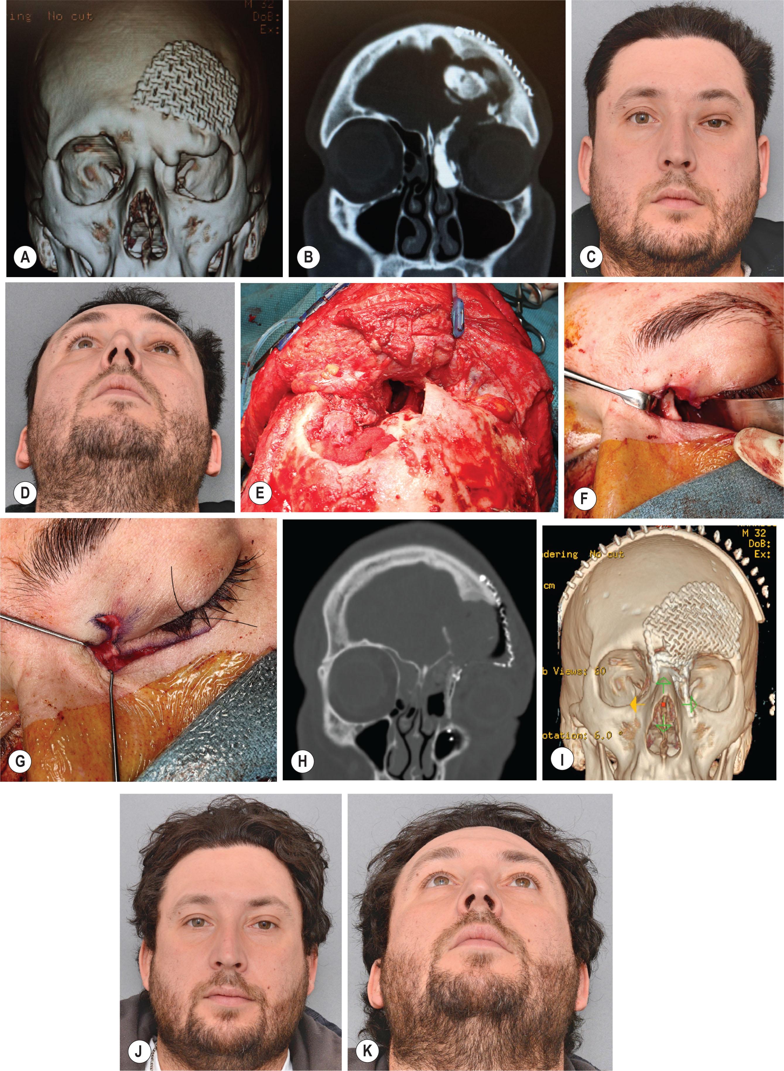 Figure 5.6, (A) A 30-year-old male with residual osteoblastoma of the left supraorbital rim and superomedial orbital cavity invading frontal sinus and ethmoid air cells. (B) Previous craniectomy elsewhere removed the frontal bone portion of tumor but left a residual expanding lesion into the left orbit and nasoethmoid regions. (C) Residual tumor in the left superomedial orbital rim caused left inferior and lateral displacement of the left globe. However, the defect in the left orbital roof allowed prolapse of orbital soft tissues into the anterior cranial fossa, with resulting left enophthalmos (D) . (E) Surgery involved a combined intra-/extracranial approach to permit retraction of cranial and orbital contents for radical excision of the residual osteoblastoma. Split calvarial bone graft was used to reconstruct the medial orbital rim and wall (F) , providing a secure fixation point for medial canthoplasty (G) . (H) Postoperative CT scan demonstrated good position of the medial orbital bone graft and titanium mesh employed in orbital roof reconstruction. (I) 3D CT scan demonstrated the skull reconstruction using patient-specific titanium mesh for the “unknown” or intra-operative defect. Postoperative images demonstrate restoration of symmetrical globe position (J) and projection (K) .