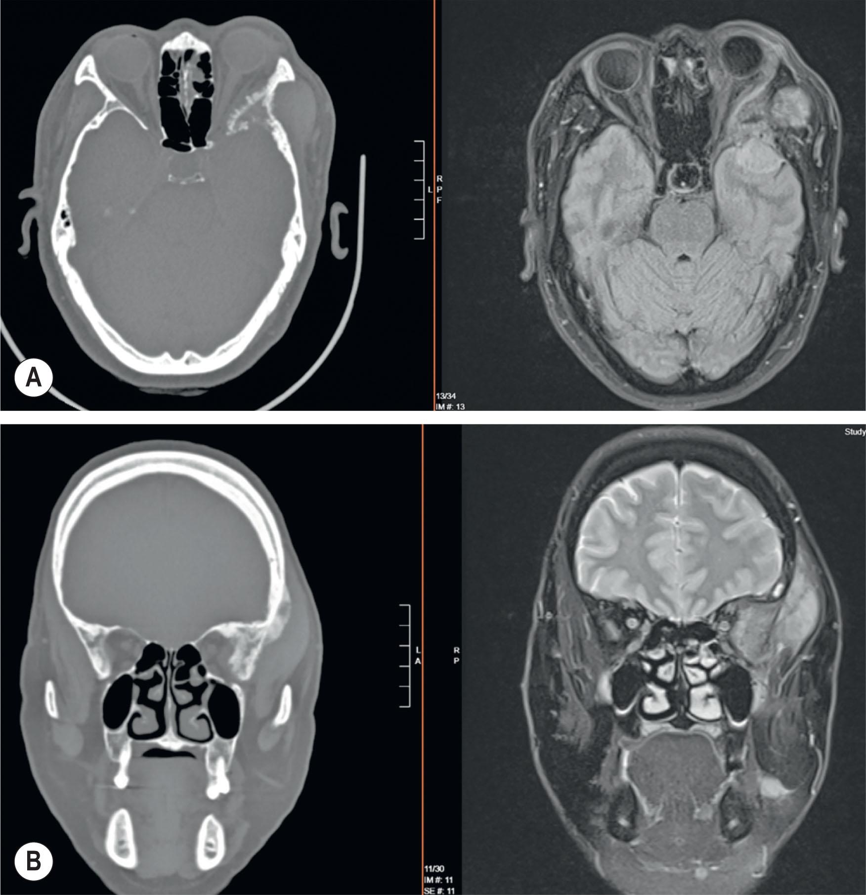Figure 5.7, Left cranio-orbital meningioma. (A) Axial CT and MRI demonstrated invasion and expansion of the sphenoid in the posterior orbit causing proptosis. (B) Coronal MRI image demonstrated expansion of tumor well beyond bone, invading soft tissues within the orbit as well as temporal fossa.