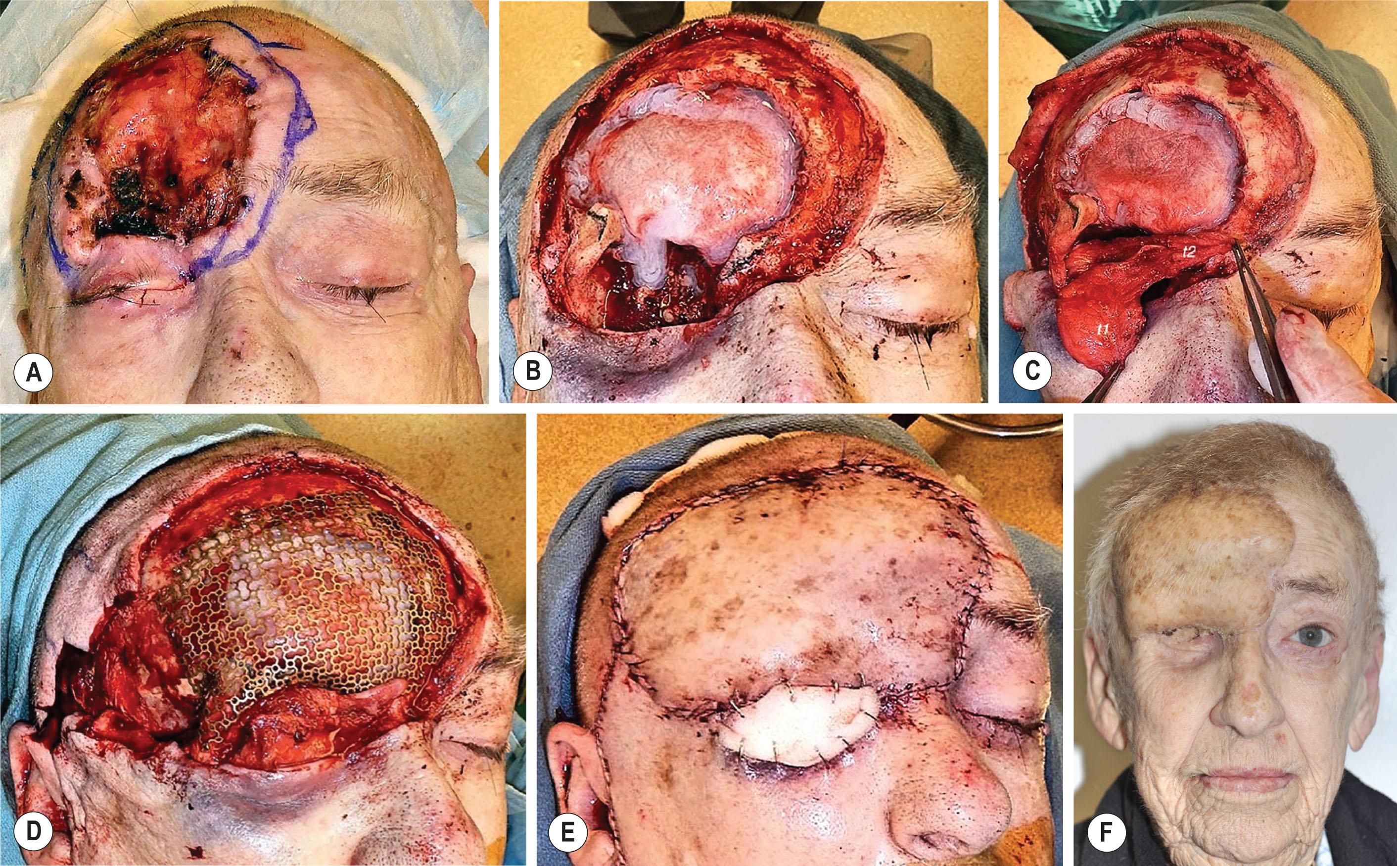 Figure 5.8, Squamous cell carcinoma infiltrating the right frontal bone, anterior cranial fossa and orbit (A) , necessitating right orbital exenteration and fronto-orbital craniectomy (B) . (C) A temporalis muscle flap was passed through a lateral orbitotomy defect. The anterior half ( t1 ) resurfaced the orbital exenteration while the posterior half ( t2 ) isolated the orbit from the cranial cavity. (D) A patient-specific titanium mesh allowed restoration of the cranio-orbital skeleton. (E,F) Free flap coverage provided protection of the titanium mesh and allowed for long-term functional results.