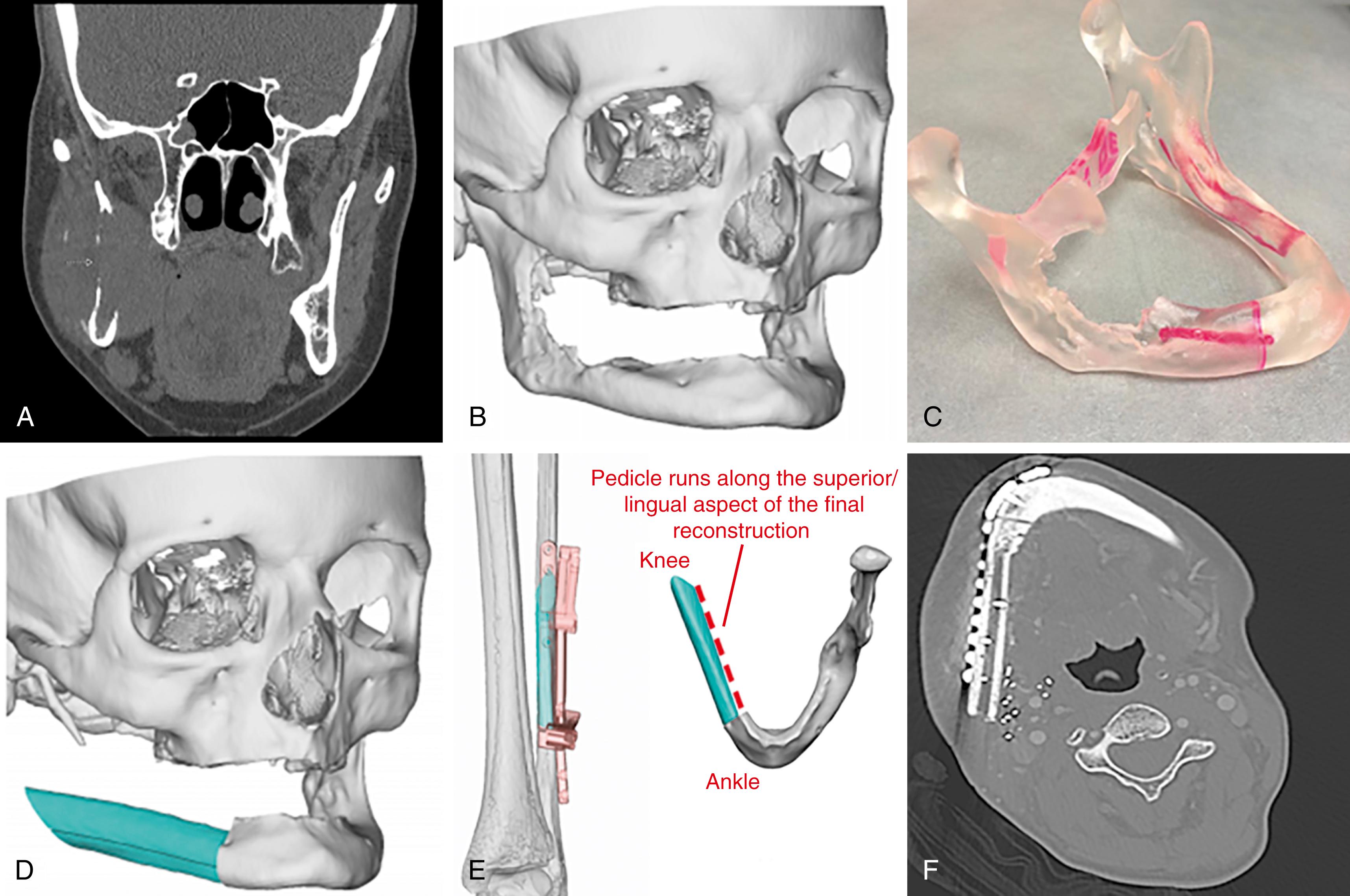 Fig. 182.1, A, A computed tomography (CT) scan of a patient demonstrating carcinoma that eroded the ramus of the mandible. B, Three-dimensional reconstruction for virtual surgical planning. C, Three-dimensional model of mandible preoperatively. D, Virtual plan with fibular reconstruction. E, Fibular resection planning. F, CT scan of postoperative view after osseocutaneous fibular free flap reconstruction.