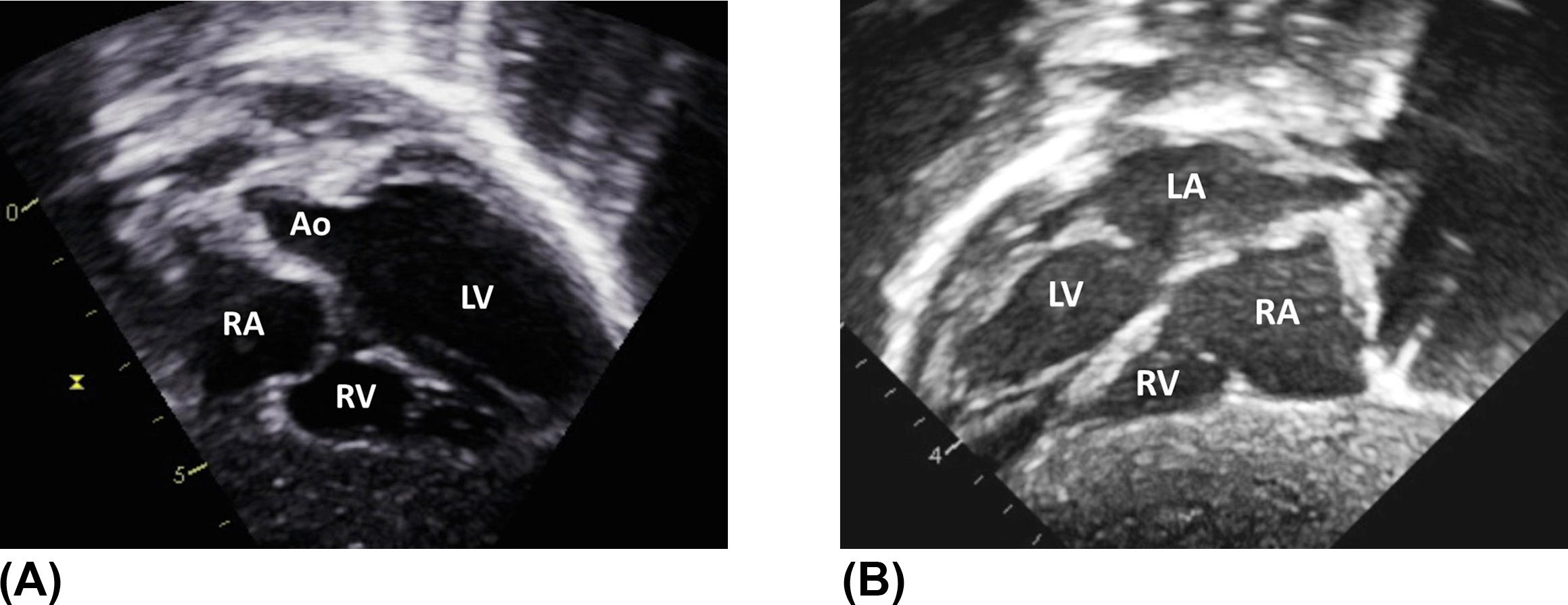 Figure 2, Subcostal long axis views demonstrating the cardiac position. (A) Levocardia with leftward orientation of the apex of the heart. (B) Dextrocardia with mirror image atrial and ventricular arrangement. (C) Mesocardia with midline orientation of the heart. Ao , aorta; LA , left atrium; LV , left ventricle; RA , right atrium; RV , right ventricle.