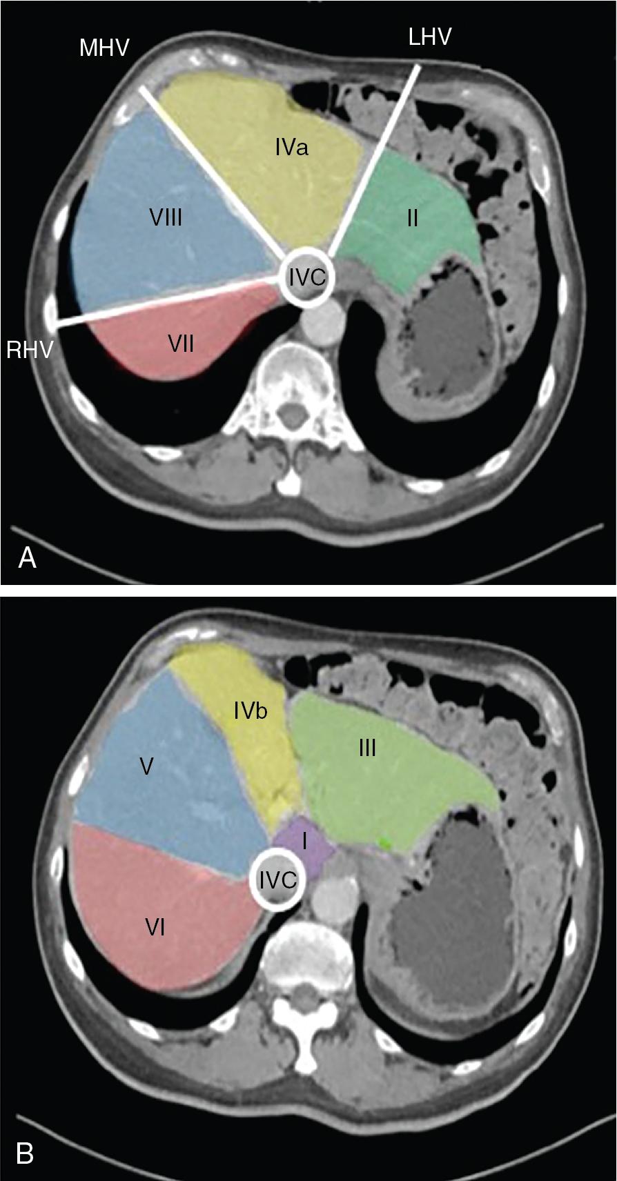 FIGURE 118B.2, The segments of the upper liver (A) and of the lower liver (B) are shown.