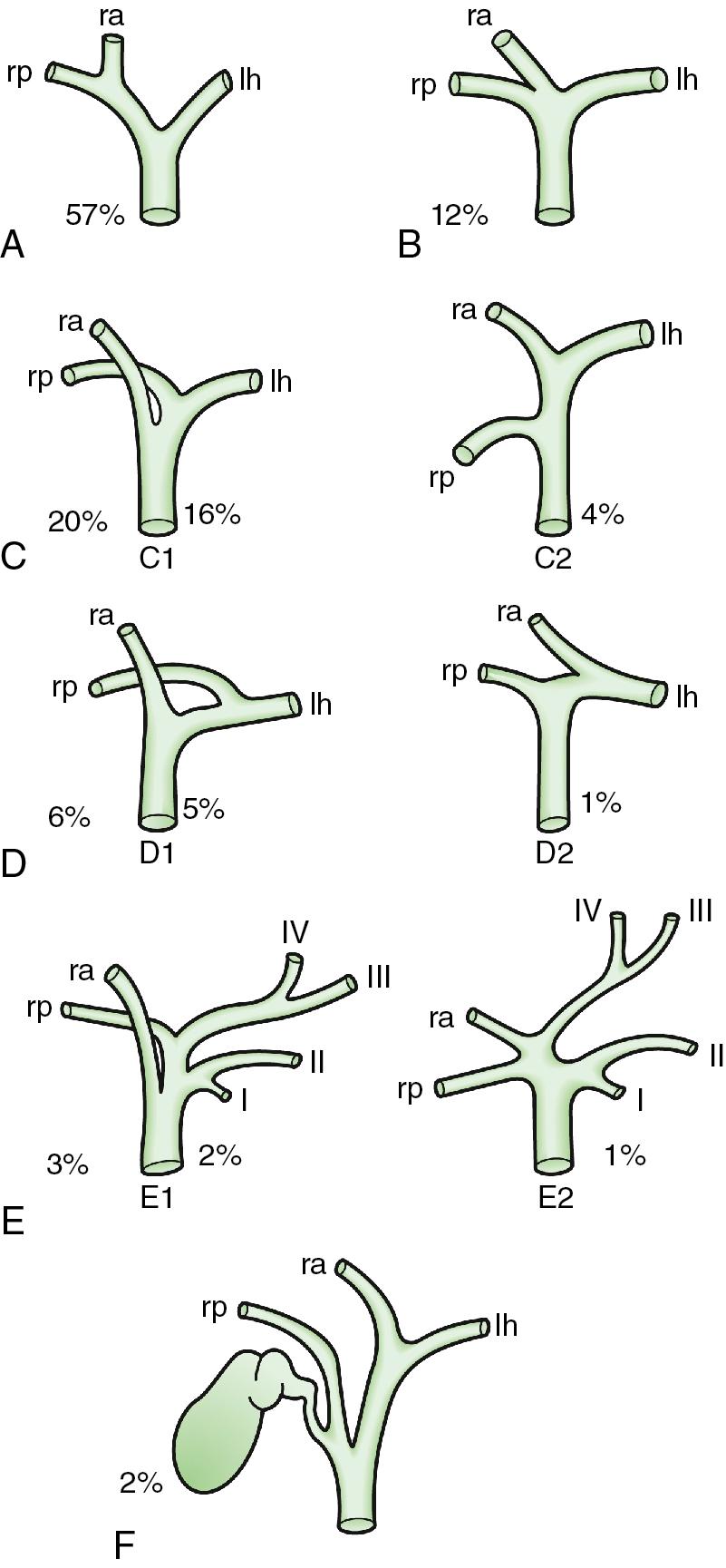 FIGURE 118B.3, Intra-hepatic biliary anatomy and known anatomic variations by frequency 16 . The anatomy described under A is the most common, conventional anatomy.