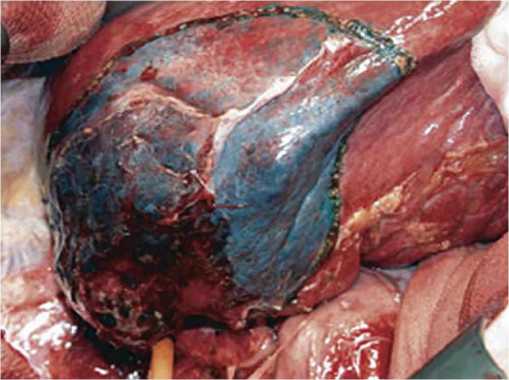 FIGURE 118B.4, Use of portal dye technique for systematic segmentectomy. 21