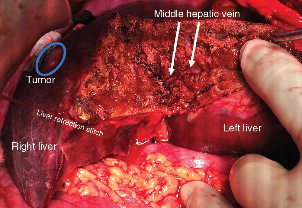 FIGURE 118B.5, Anterior approach to right hepatectomy—initial transection. The transection line follows Cantlie’s line/the principle plane, just to the right of the middle hepatic vein. 1-0 chromic suture is used to facilitate retraction of the left and right liver as it is being divided.