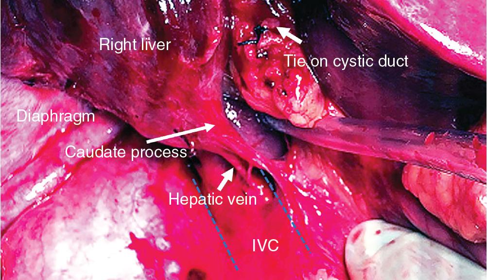 FIGURE 118B.7, Mobilization of the right liver with exposure of the short hepatic veins. The inferior vena cava (IVC) trajectory is marked with dotted blue lines . Note the large inferior hepatic vein draining the caudate process to the vena cava.