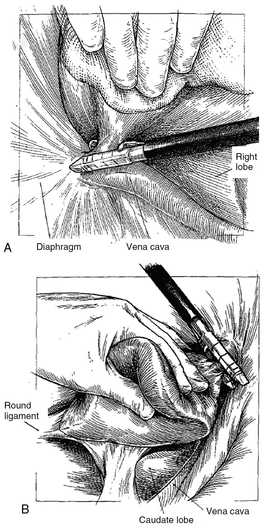 FIGURE 118B.8, Stapled ligation of the (A) right hepatic vein and (B) the left hepatic vein. 39