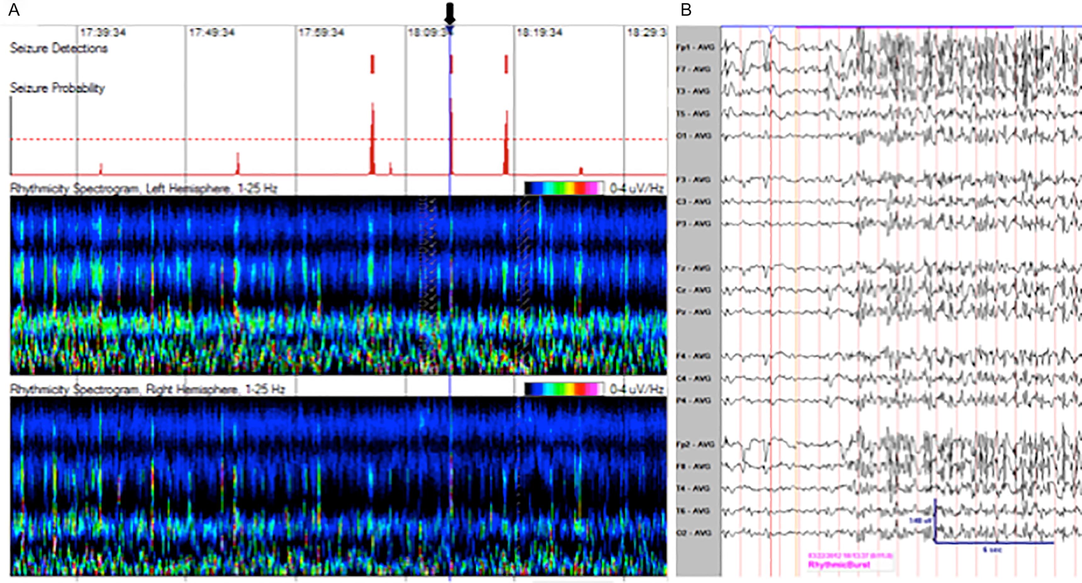 Figure 57-1, A , Quantitative EEG. EEG for 1 h in a young man intubated for respiratory failure with symptomatic generalized epilepsy and subtle tonic seizures. The upper two panels use a proprietary algorithm to calculate the probability of seizures over time (Persyst seizure detection, Persyst Corporation, San Diego, CA). The lower two panels show time along the x -axis, frequency on the y -axis (0–25 Hz) and EEG on a color scale. Most power is in the delta range for most of the tracing. There is an asymmetry in faster frequencies, increased over the left hemisphere. Intermittent bursts of power in higher frequencies represent brief electrographic seizures, with subtle or no clinical correlate on video. B , EEG recorded using an average reference and corresponding to the arrow in A .