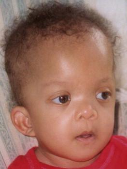 Figure 29.3, Cardiofaciocutaneous syndrome in an infant with a confirmed BRAF mutation. The sparse curly hair and eyebrows and characteristic facial features are evident.