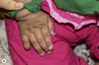 Figure 29.4, (A) The characteristic loose, redundant skin of the hand and (B) acanthosis nigricans behind the ear lobe in an individual with Costello syndrome.