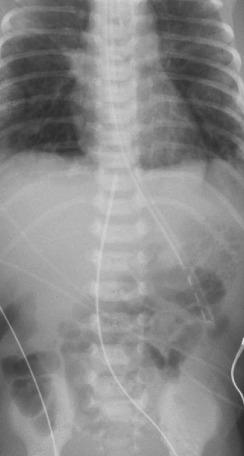 Fig. D.4, Anteroposterior radiographic image showing the preferred location of the umbilical vein catheter tip at the most superior portion of the inferior vena cava, where it receives the hepatic veins and the ductus venosus and is about to empty into the right atrium.