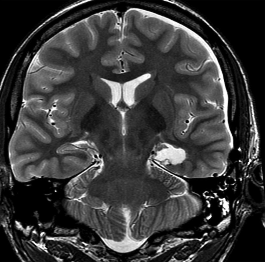 Figure 94B.1, A coronal T2-weighted MR image demonstrating complete resection of the mesial temporal structures with preservation of the temporal stem and superficial cortex after a subtemporal approach.