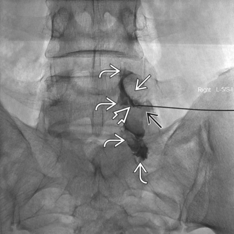 Intraforaminal and Epidural Injection