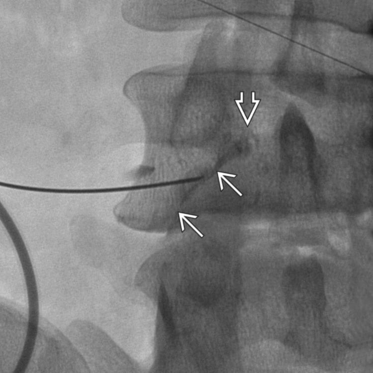 Intraforaminal and Epidural Injection