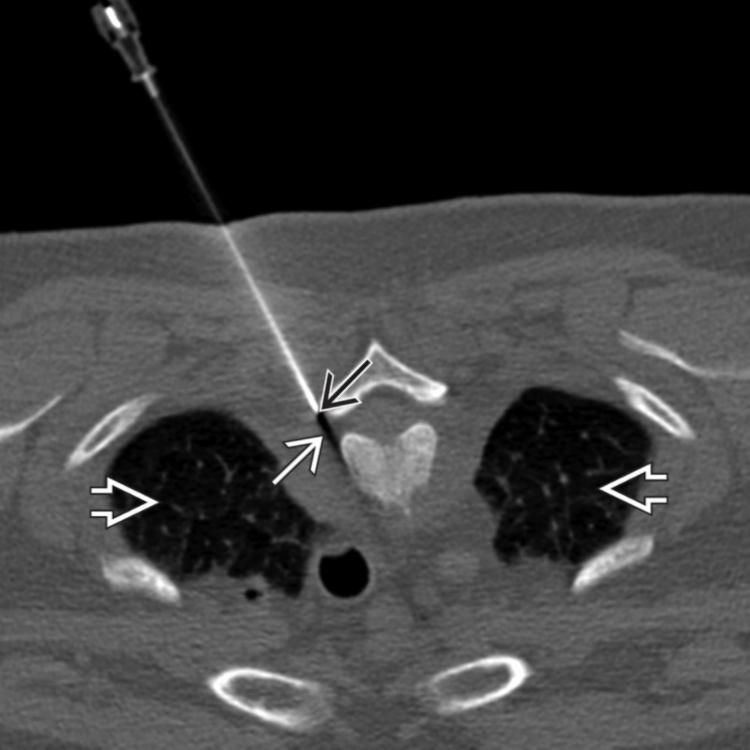 Needle Placement: CT