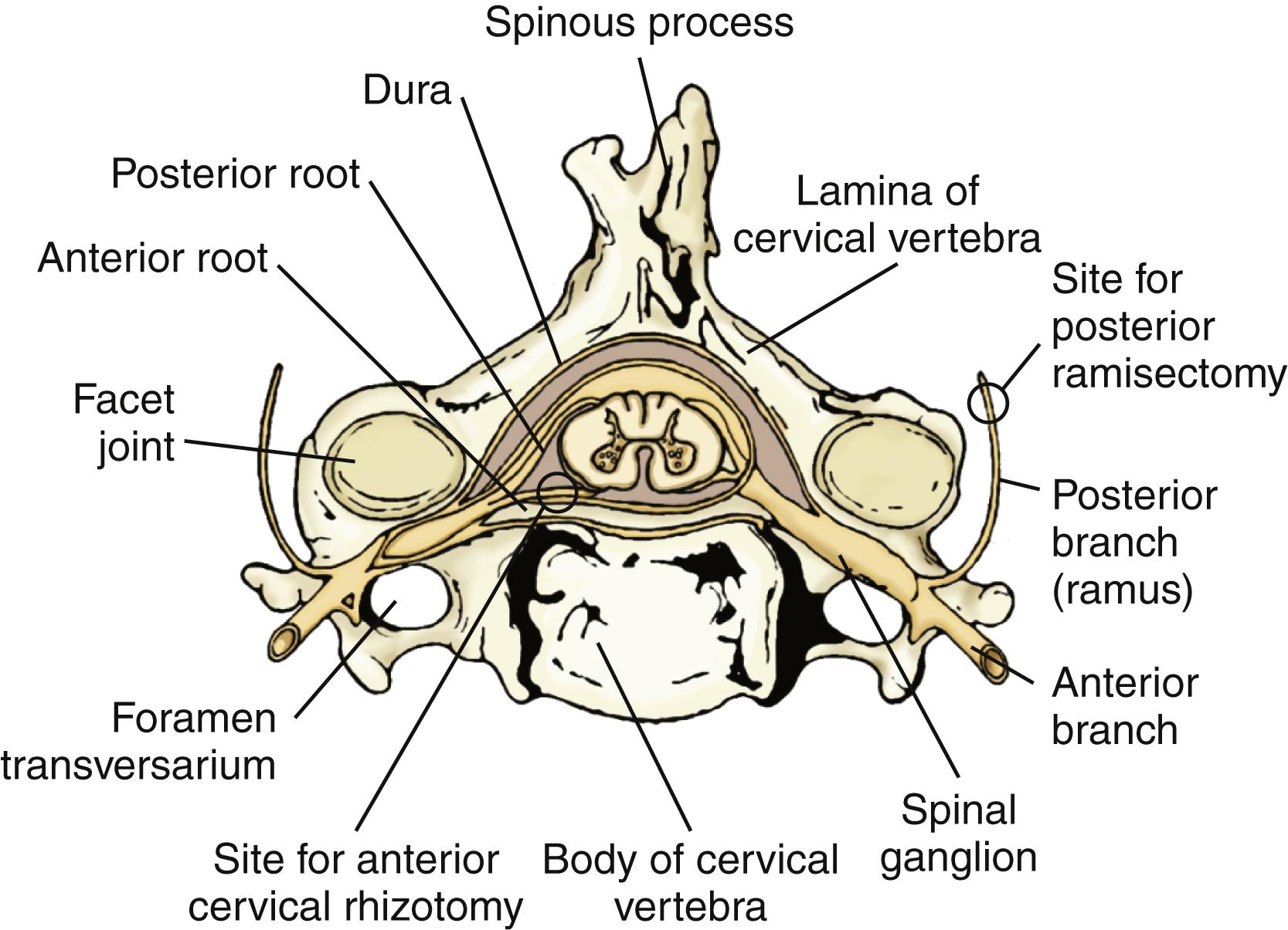 Figure 118.2, Anatomy of anterior cervical rhizotomy (intradural approach) and posterior ramisectomy (extradural approach).