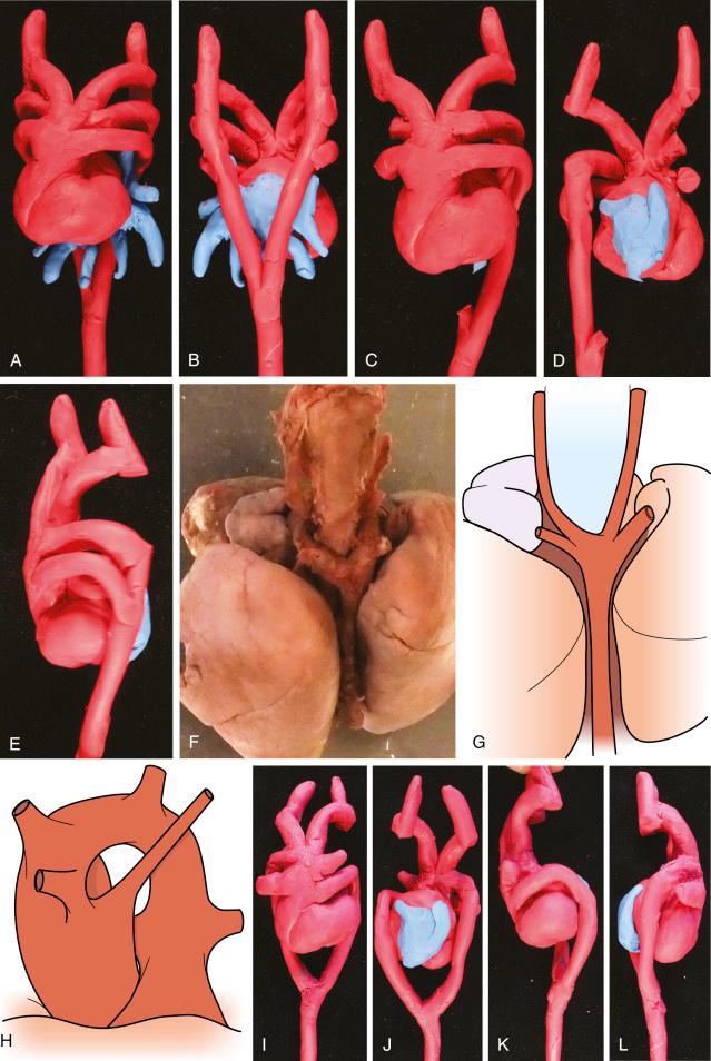 • eFig. 10.3, An idealised model of the developing vascular system at about 35 days of development viewed from the ventral aspect ( A ) and the dorsal aspect ( B ). The folded heart tube is seen in the centre of the picture. From the aortic sac, three pairs of aortic arches arise, from superior to inferior: arch 3, arch 4 and arch 6. Arches 1 and 2 have already involuted. The arches connect to the paired dorsal aortae that are fused in their caudal parts. It is from arches 3, 4 and 6 with their associated parts of dorsal aortae that the definitive arterial system of the thorax develops. The three pairs of veins entering the horns of the sinus venosus are represented in blue. From lateral to medial they are the cardinal veins, umbilical veins and vitelline veins.