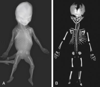 • eFig. 13.2, Postmortem imaging of a normal 20-week gestation fetus with conventional radiography (i.e. a skeletal survey) ( A ) and after a volume rendered reconstruction of the ossified skeleton from conventional computed tomography imaging of the whole body ( B ).