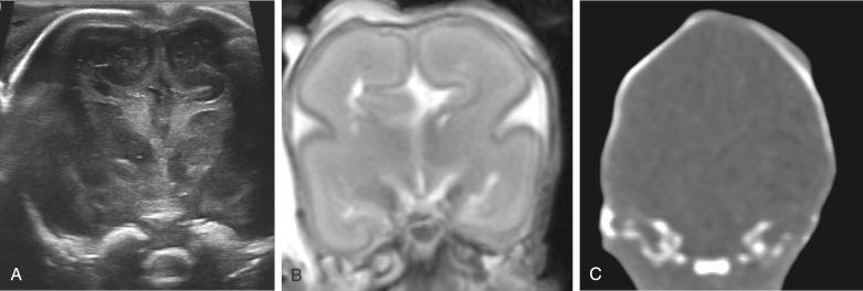 • eFig. 13.3, Postmortem imaging of a normal brain in a 19-week gestation fetus using ultrasonography ( A ), T2-weighted MRI sequences ( B ) and noncontrast computed tomography (CT) ( C ). Note the difference in brain parenchymal and ventricular anatomy on both on ultrasonography and MRI compared with the homogenous density of the intracranial structures seen on the CT imaging, where it is impossible to differentiate any intracranial structures apart from the skull encasing them.