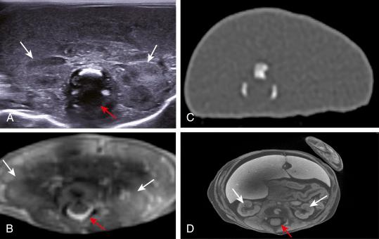 • eFig. 13.4, Postmortem imaging of a normal abdomen in a 19-week gestation fetus. Images are demonstrated in the axial plane at the level of the renal hila on ultrasonography ( A ), T2-weighted magnetic resonance imaging (MRI) sequences ( B ) and noncontrast computed tomography (CT) ( C ). The ultrasound and MRI images allow for visualisation of the kidneys (white arrows) ; however, artefact from the vertebral bodies obscure views of the spinal canal, which is better seen on the MRI study (red arrows) . On CT imaging, the internal organs are not appreciated, although the appearances of the vertebral ossification centres are best seen with this modality.