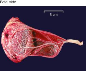 • eFig. 7.2, From Klatt, Edward C., MD Robbins and Cotran Atlas of Pathology, Third Edition. Copyright © 2015 by Saunders, an imprint of Elsevier Inc.