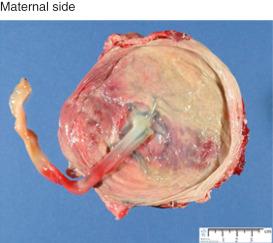 • eFig. 7.3, From Humpath.com - Human pathology, http://www.humpath.com/spip.php?article3272 .